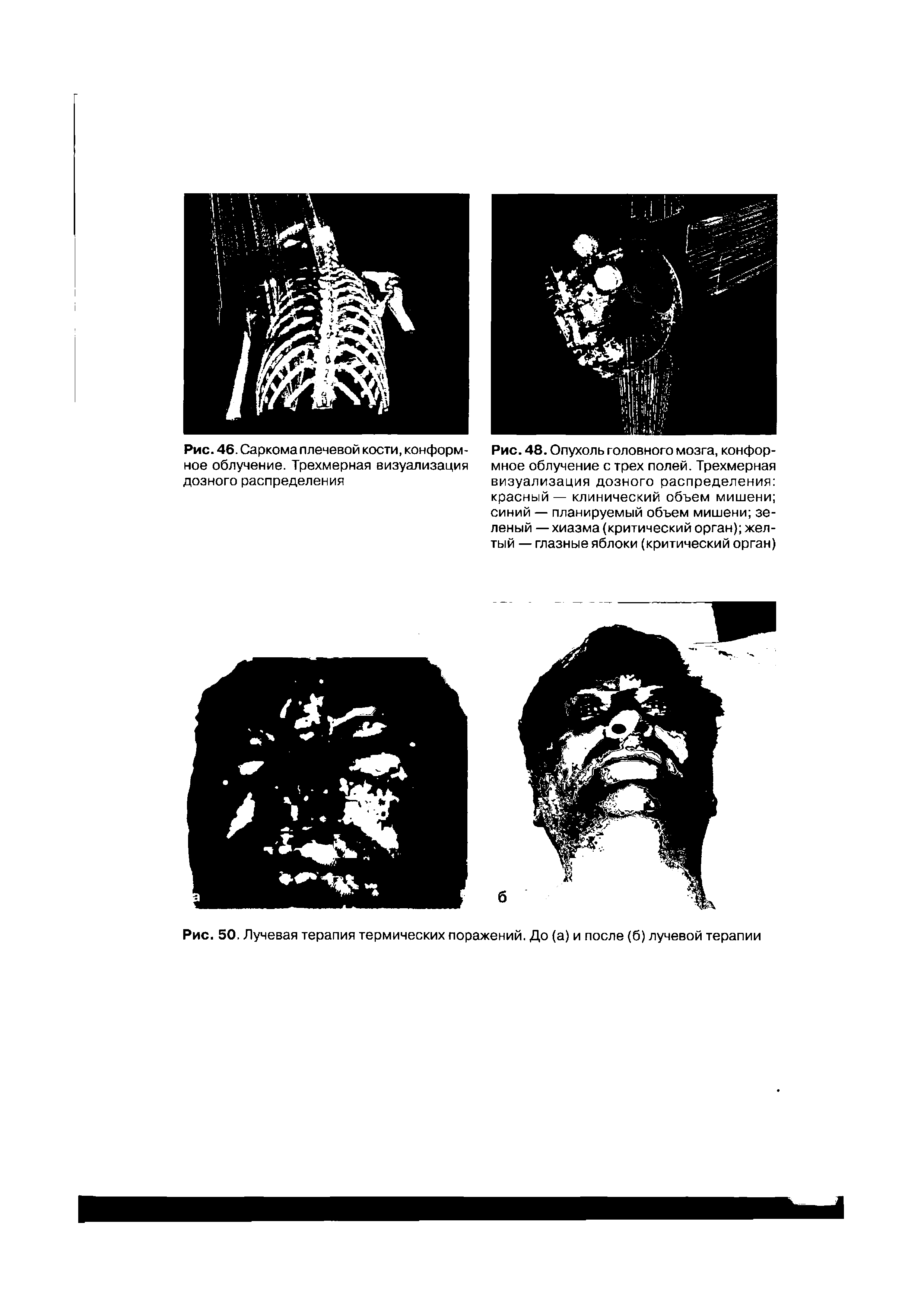 Рис. 48. Опухоль головного мозга, конформное облучение с трех полей. Трехмерная визуализация дозного распределения красный — клинический объем мишени синий — планируемый объем мишени зеленый — хиазма (критический орган) желтый — глазные яблоки (критический орган)...