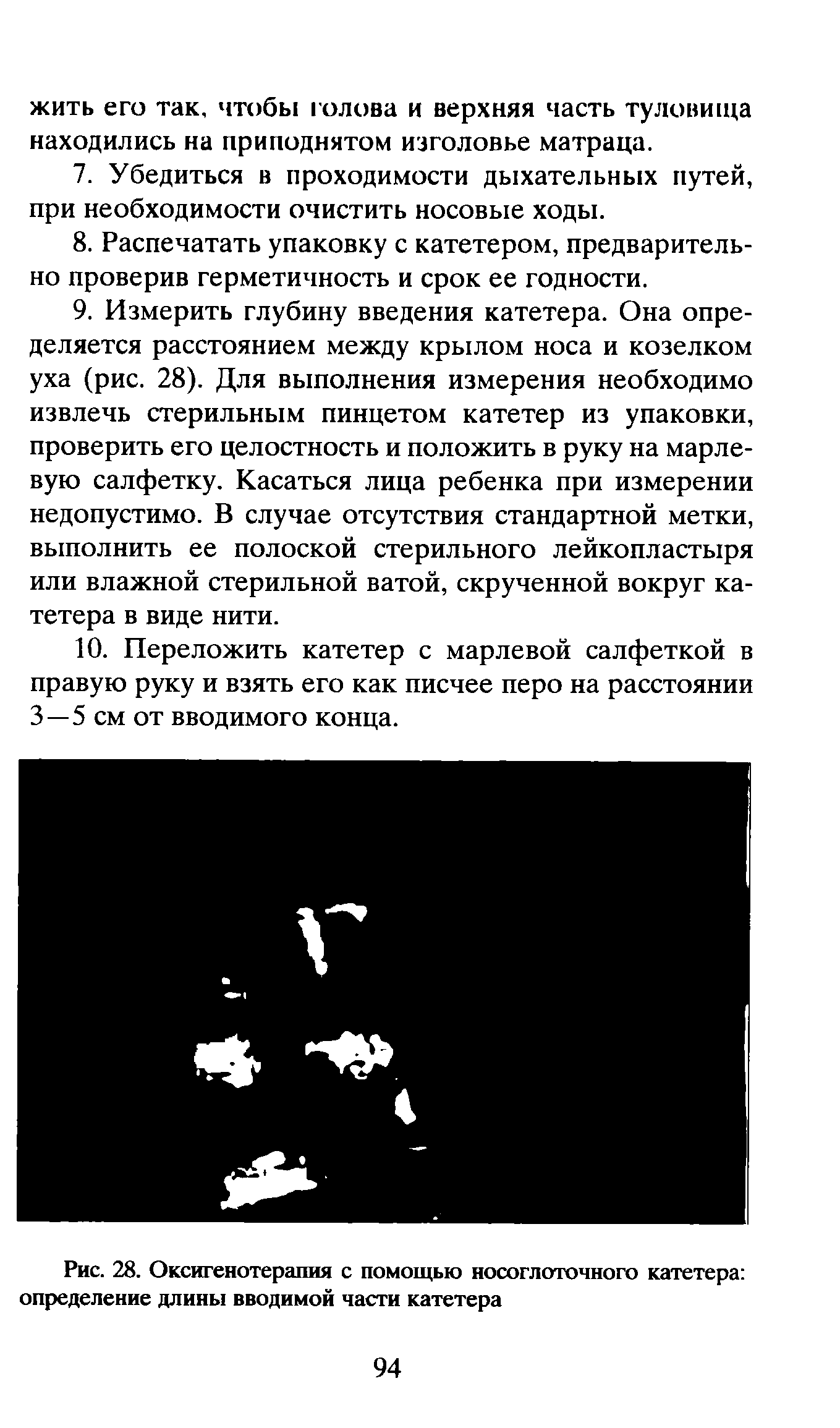 Рис. 28. Оксигенотерапия с помощью носоглоточного катетера определение длины вводимой части катетера...