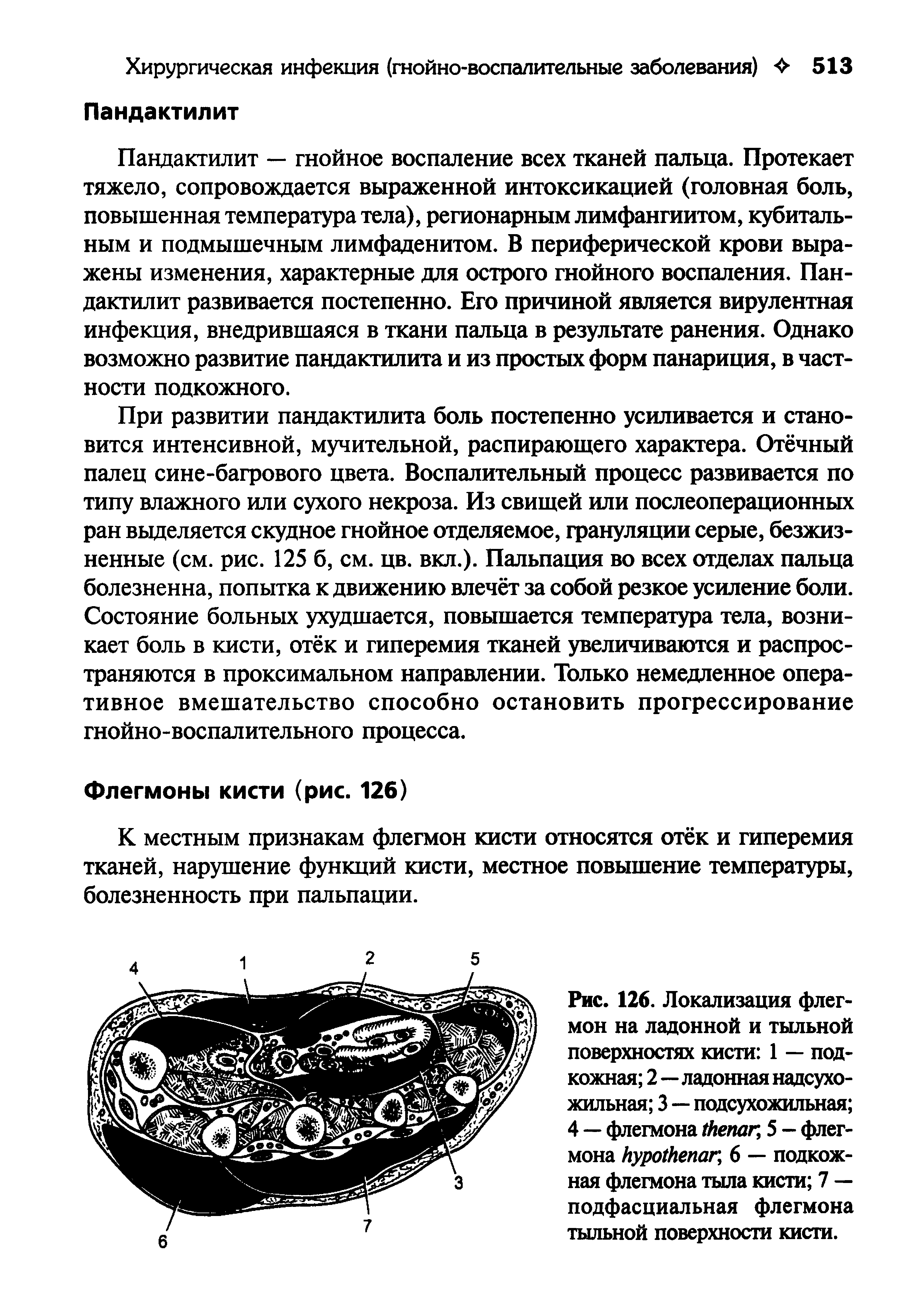 Рис. 126. Локализация флегмон на ладонной и тыльной поверхностях кисти 1 — подкожная 2—ладонная надсухожильная 3 — подсухожильная 4 — флегмона , 5 - флегмона , 6 — подкожная флегмона тыла кисти 7 — подфасциальная флегмона тыльной поверхности кисти.