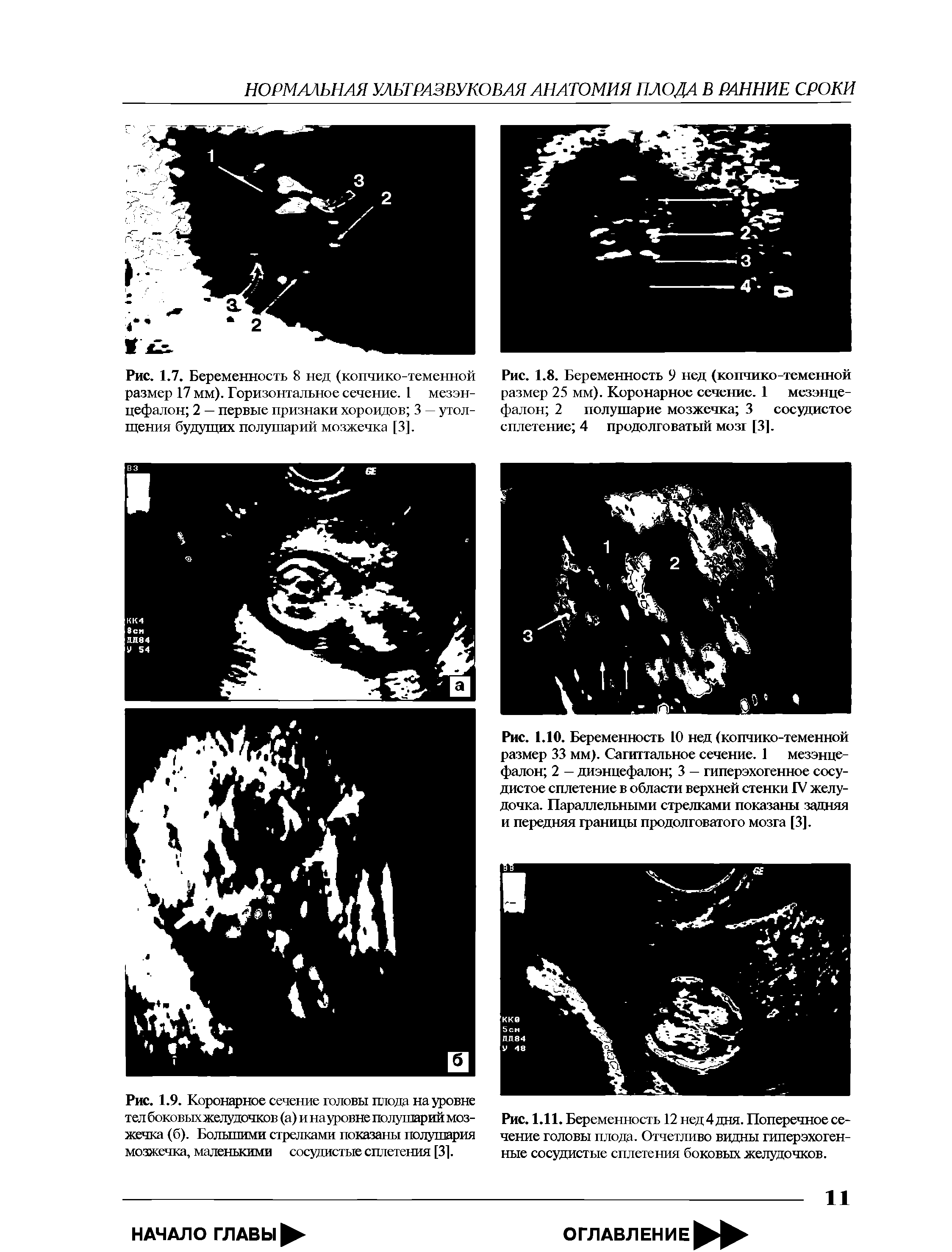 Рис. 1.9. Коронарное сечение головы плода на уровне тел боковыхжелудочков (а) и науровне полушарий мозжечка (б). Большими стрелками показаны полушария мозжечка, маленькими сосудистые сплетения [31.