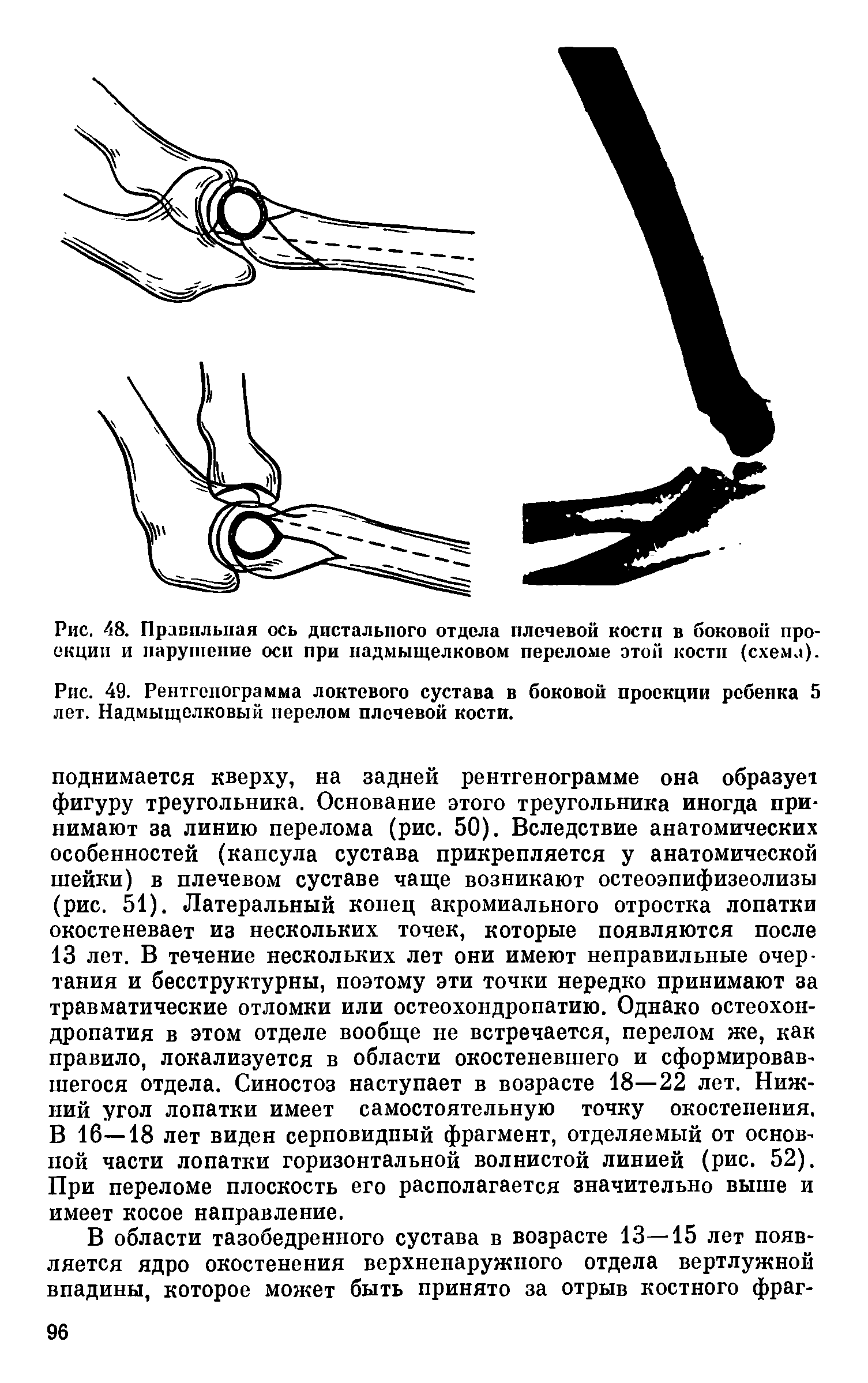 Рис. 49. Рентгенограмма локтевого сустава в боковой проекции ребенка 5 лет. Надмыщелковый перелом плечевой кости.