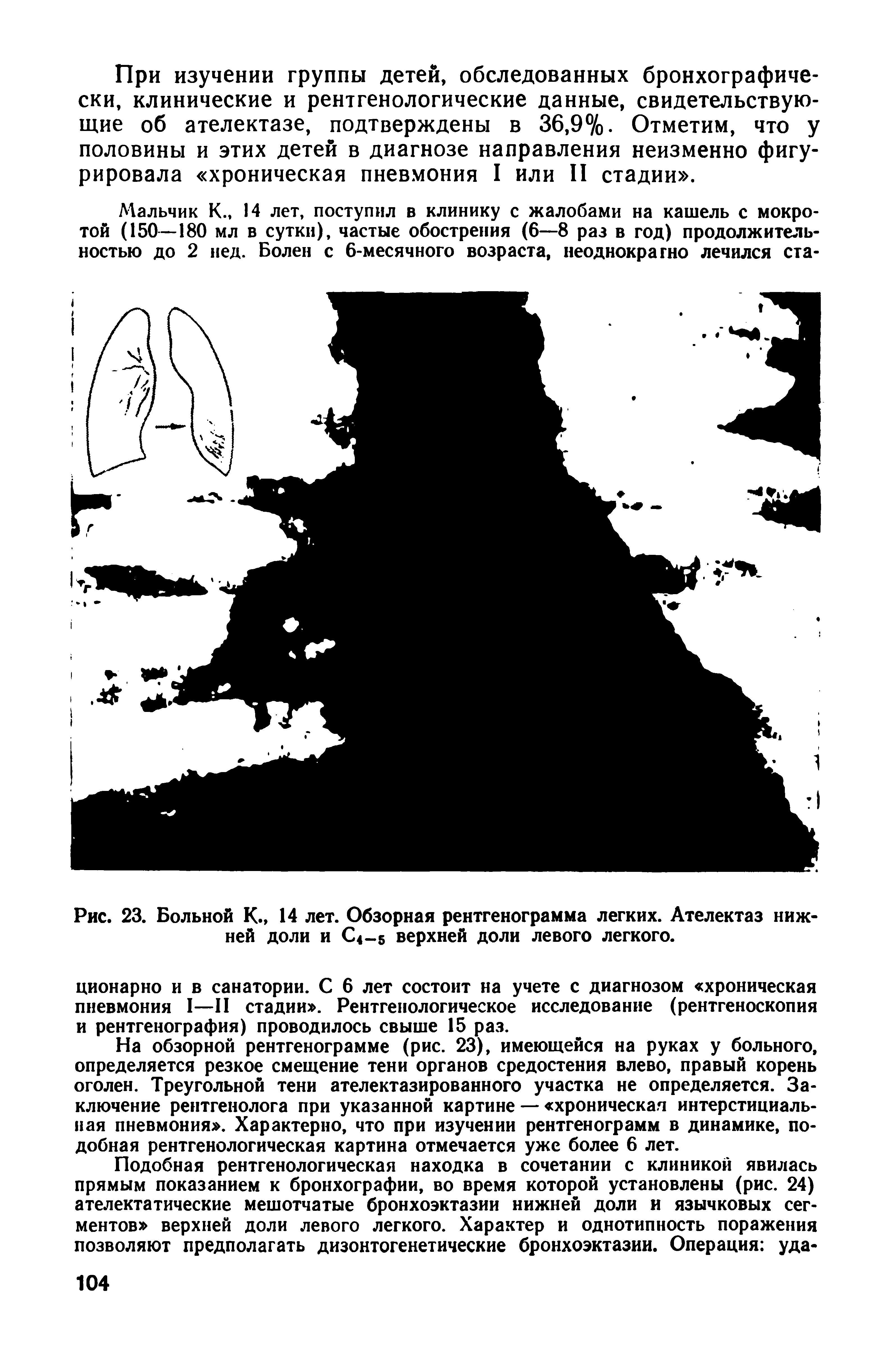 Рис. 23. Больной К., 14 лет. Обзорная рентгенограмма легких. Ателектаз нижней доли и С<-5 верхней доли левого легкого.