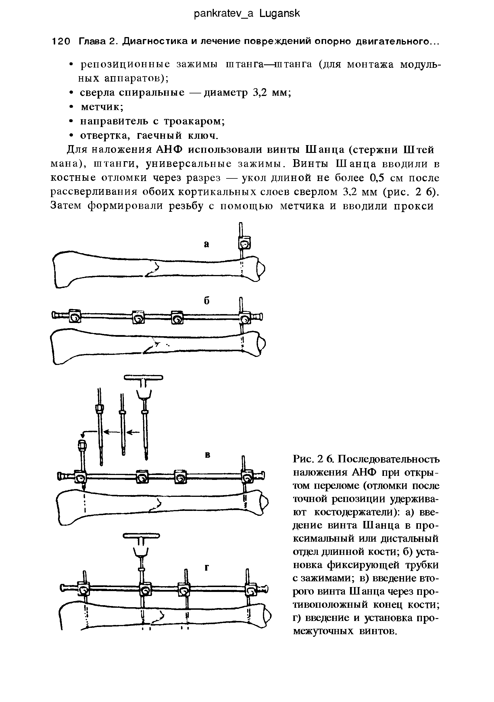 Рис. 2 6. Последовательность наложения АНФ при открытом переломе (отломки после точной репозиции удерживают костодержатели) а) введение винта Шанца в проксимальный или дистальный отдел длинной кости б) установка фиксирующей трубки с зажимами в) введение второго винта Шанца через противоположный конец кости г) введение и установка промежуточных винтов.
