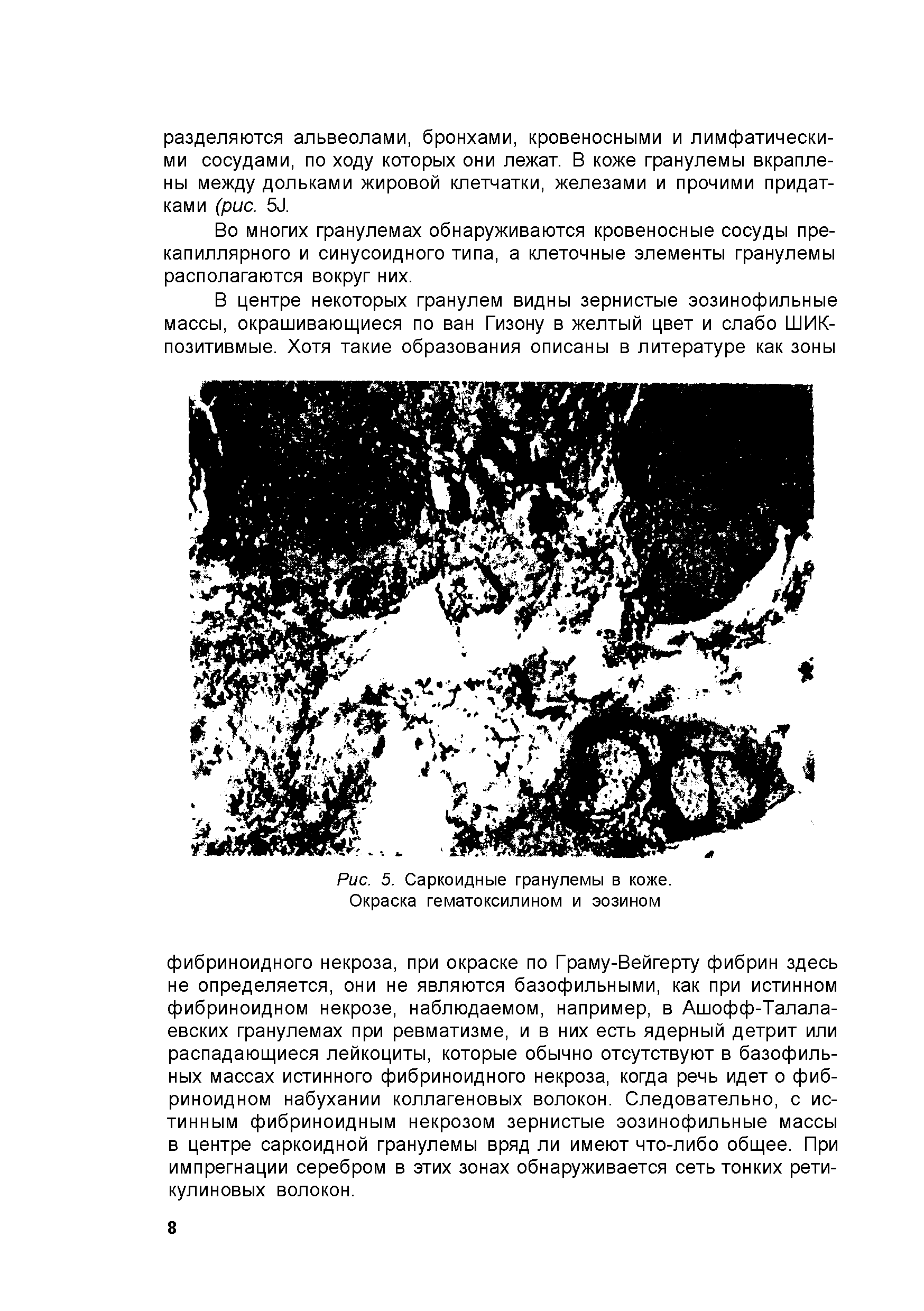 Рис. 5. Саркоидные гранулемы в коже. Окраска гематоксилином и эозином...