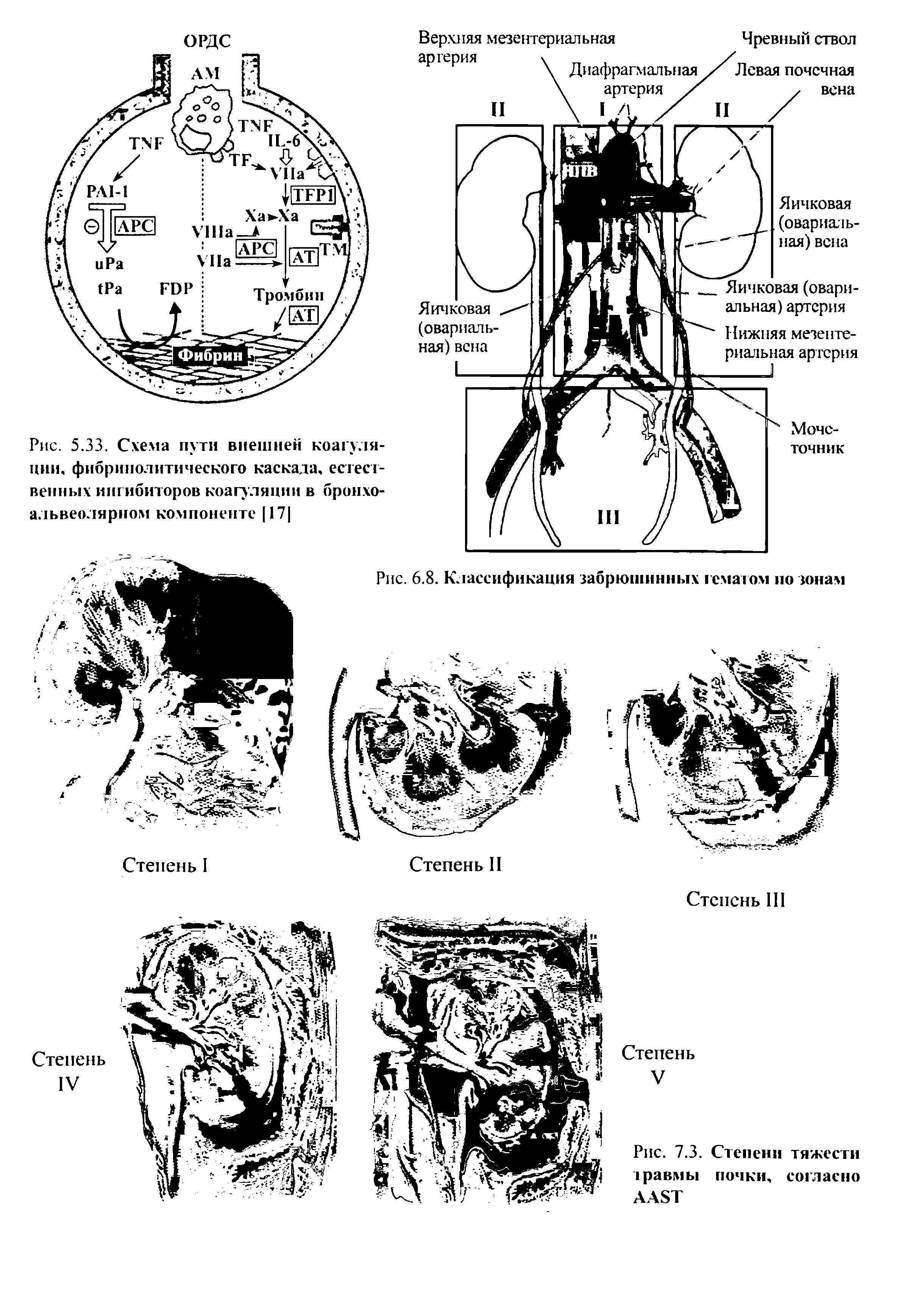 Рис. 7.3. Степени тяжести травмы почки, согласно AAST...