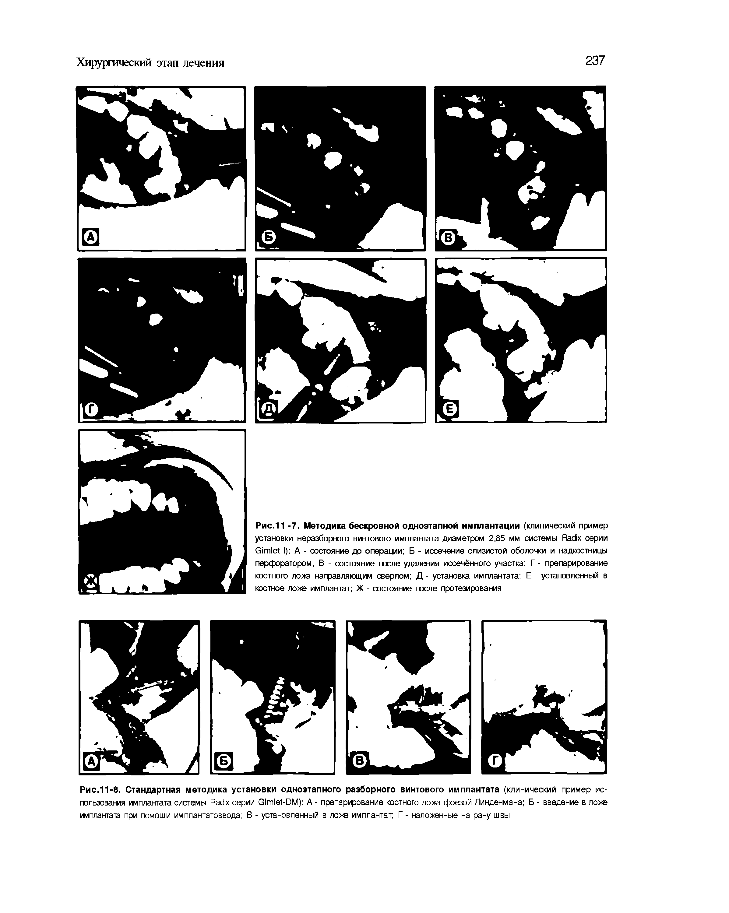 Рис.11-8. Стандартная методика установки одноэтапного разборного винтового имплантата (клинический пример использования имплантата системы R серии G -DM) А - препарирование костного лоха фрезой Линденмана Б - введение в лох имплантата при помощи имплантатоввода В - установленный в лох имплантат Г - налохенные на рану швы...