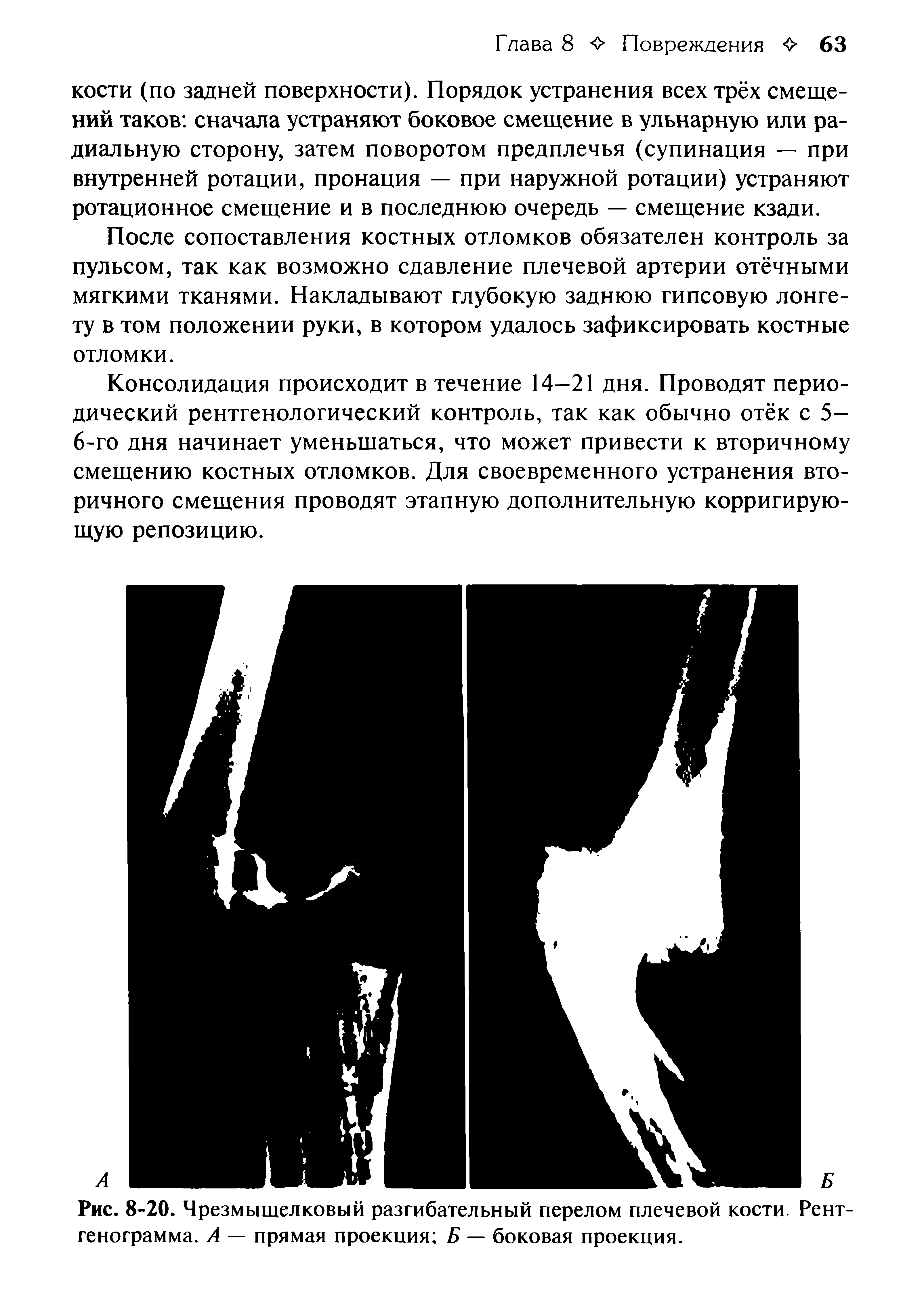 Рис. 8-20. Чрезмыщелковый разгибательный перелом плечевой кости Рентгенограмма. А — прямая проекция Б — боковая проекция.