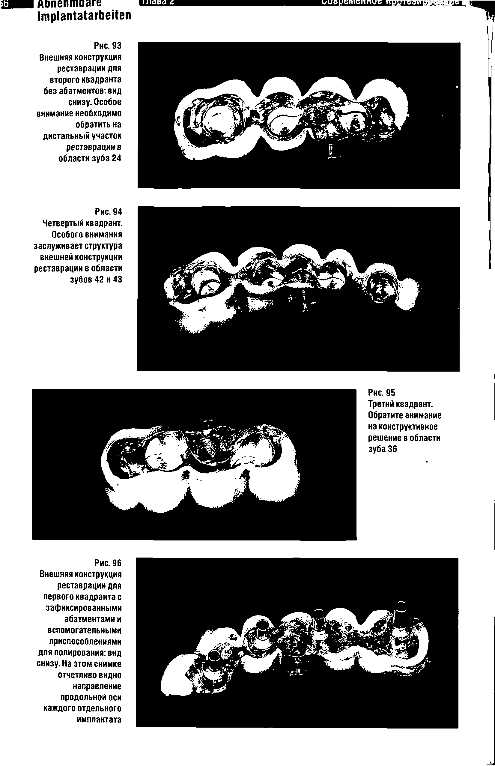 Рис. 94 Четвертый квадрант. Особого внимания заслуживает структура внешней конструкции реставрации в области зубов 42 и 43...
