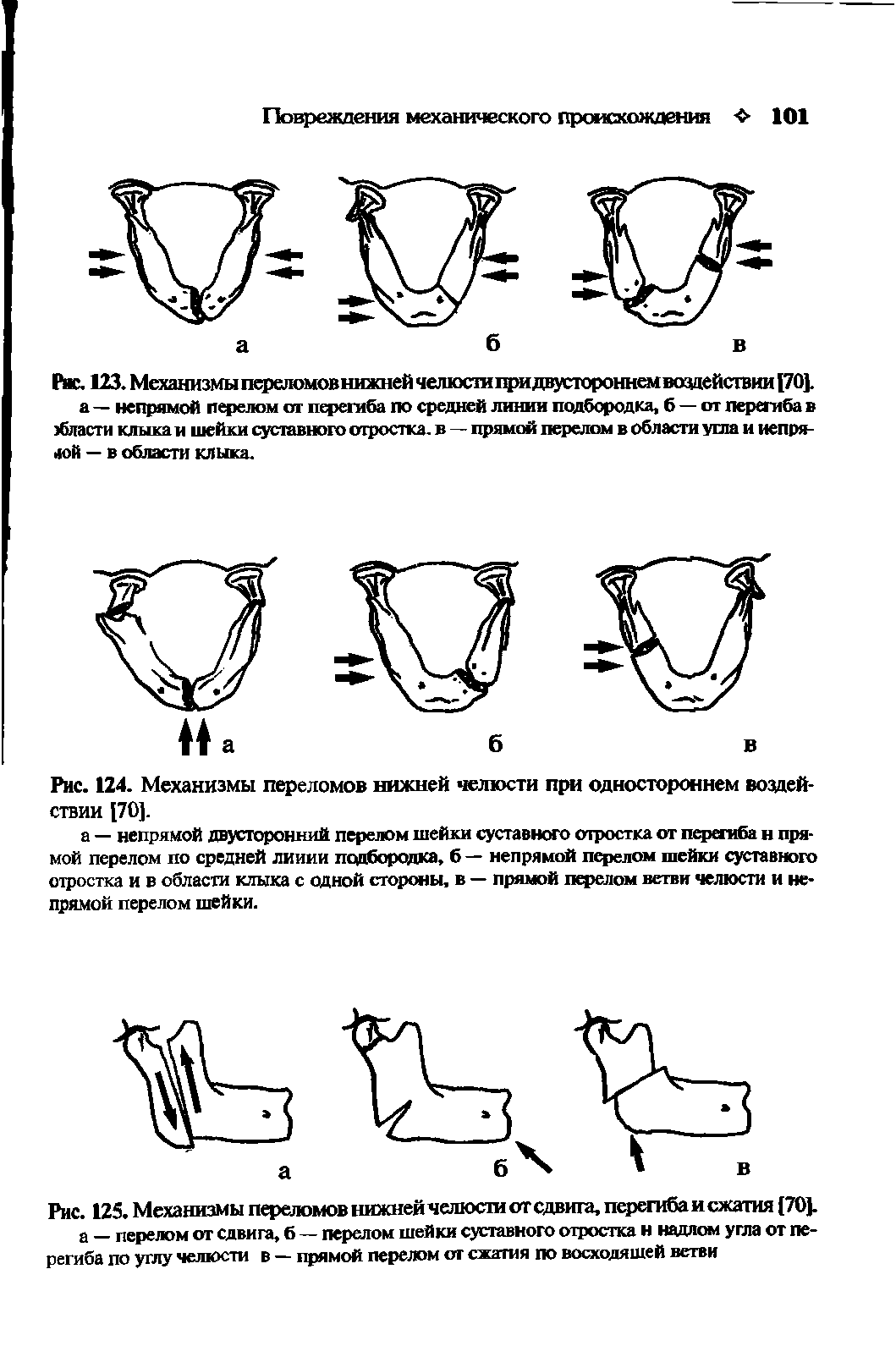 Рис. 125. Механизмы переломов нижней челюсти от сдвига, перегиба и сжатия (70]. а — перелом от сдвига, б — перелом шейки суставного отростка н надлом угла от перегиба по углу челюсти в — прямой перелом от сжатия по восходящей ветви...
