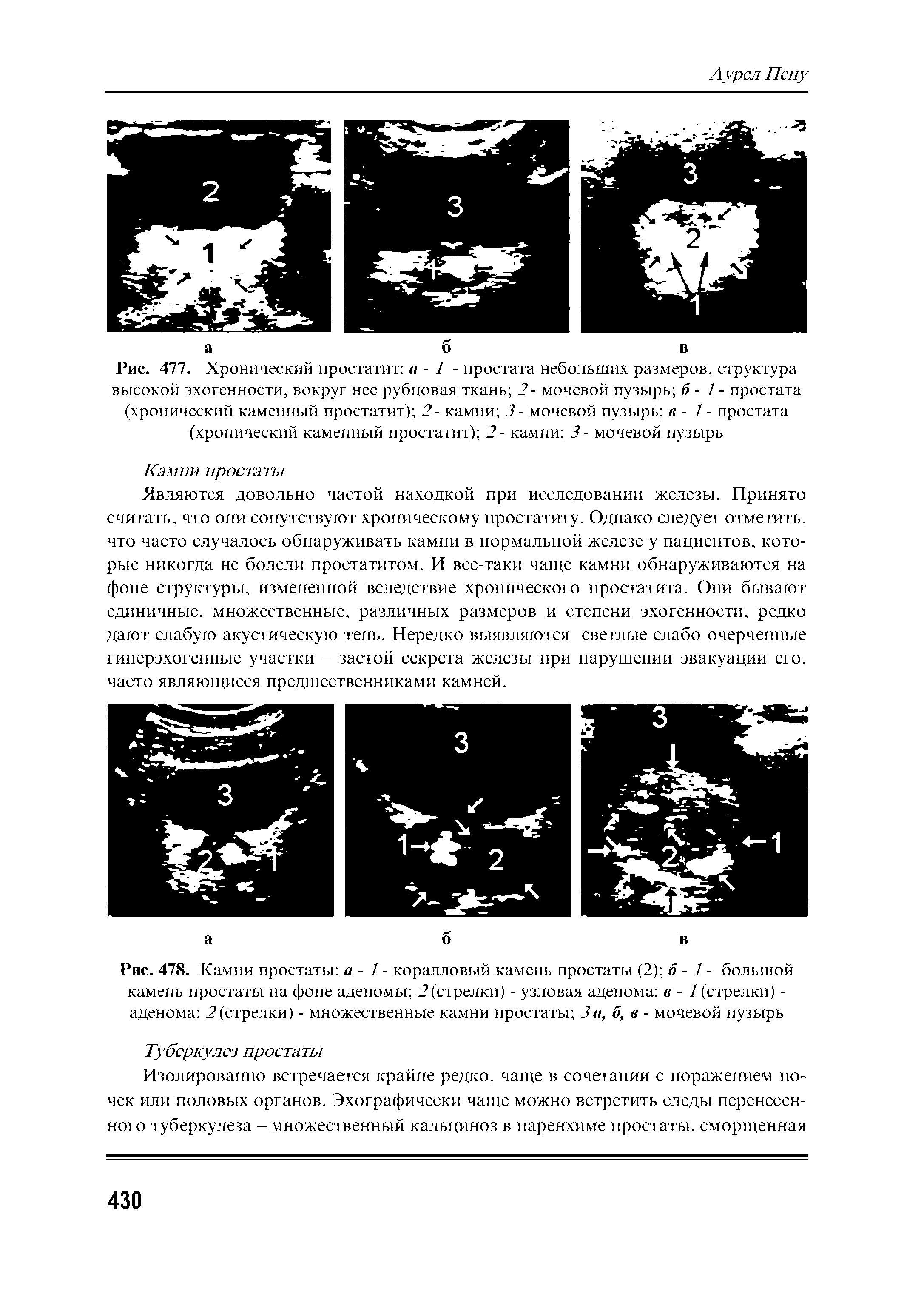 Рис. 478. Камни простаты а - 1 - коралловый камень простаты (2) б - / - большой камень простаты на фоне аденомы 2(стрелки) - узловая аденома в - / (стрелки) -аденома 2(стрелки) - множественные камни простаты За, б, в - мочевой пузырь...