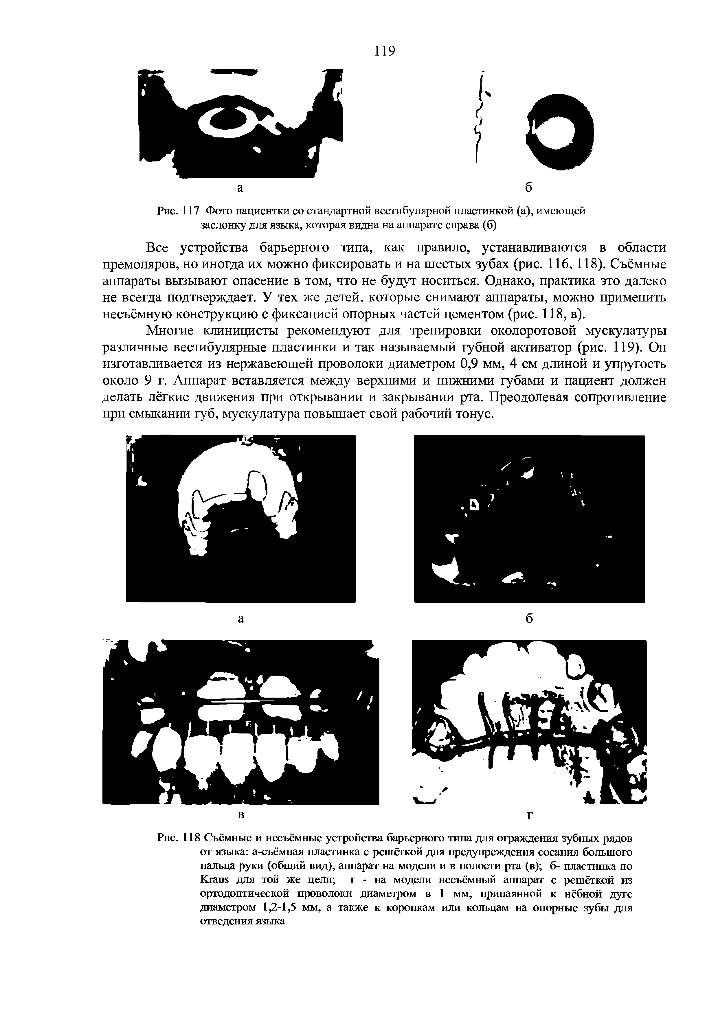 Рис. 117 Фото пациентки со стандартной вестибулярной пластинкой (а), имеющей заслонку для языка, которая видна на аппарате справа (б)...