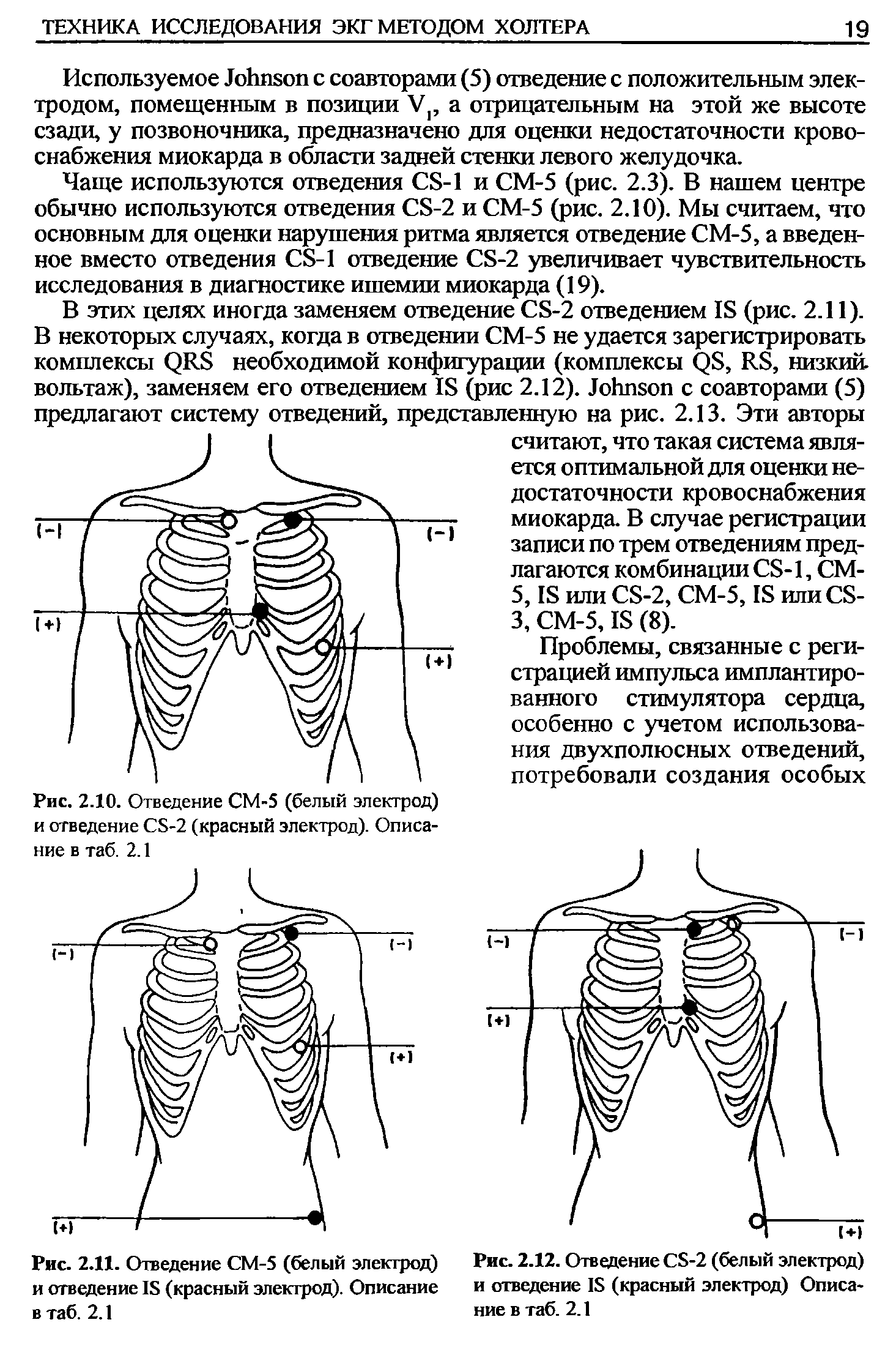 Рис. 2.10. Отведение СМ-5 (белый электрод) и отведение С5-2 (красный электрод). Описание в таб. 2.1...