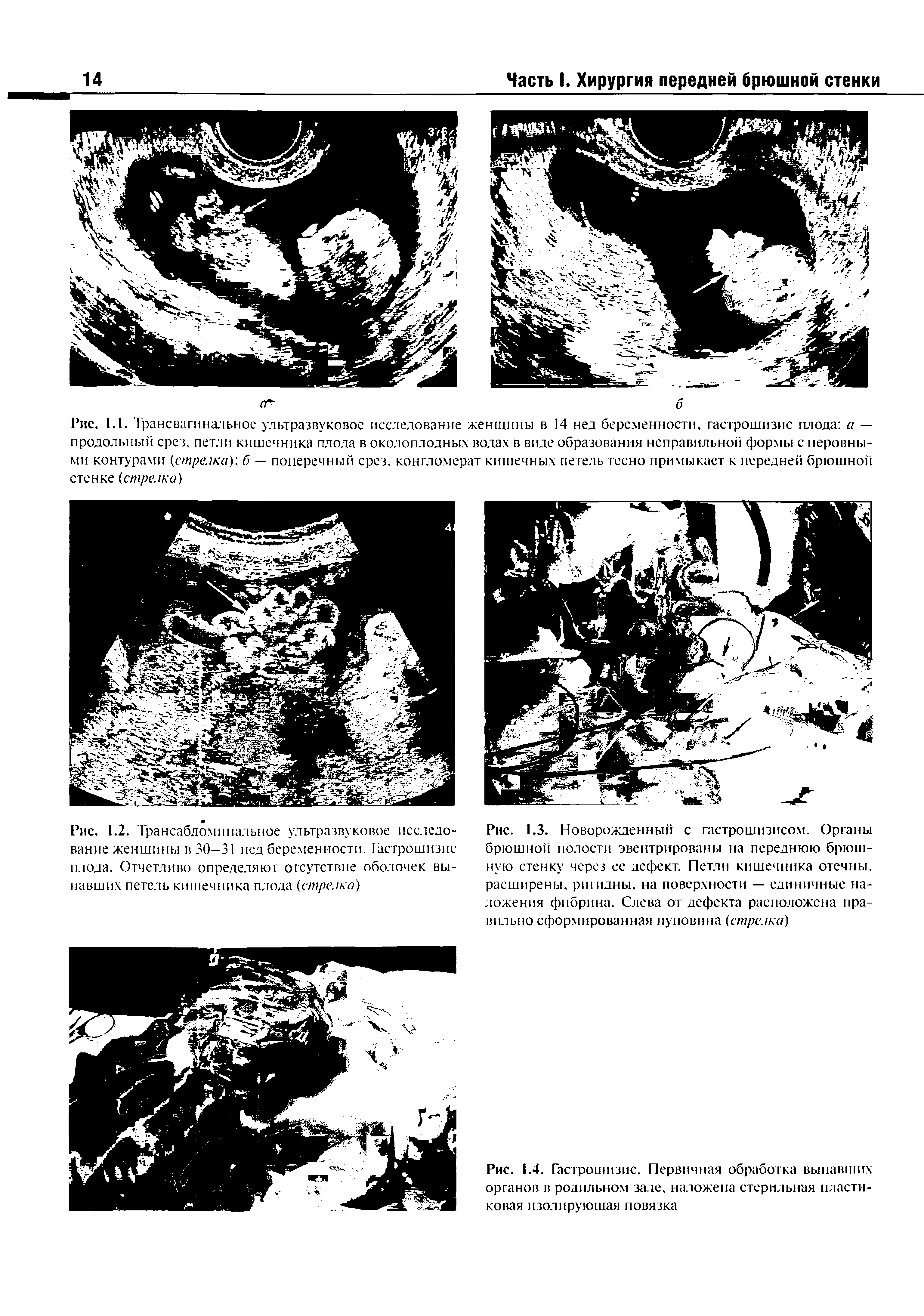 Рис. 1.1. Трансвагинальное ультразвуковое исследование женщины в 14 нед беременности, гастрошизис плода а — продольный срез, петли кишечника плода в околоплодных водах в виде образования неправильной формы с неровными контурами (стрелка) , б — поперечный срез, конгломерат кишечных петель тесно примыкает к передней брюшной стенке (стрелка)...