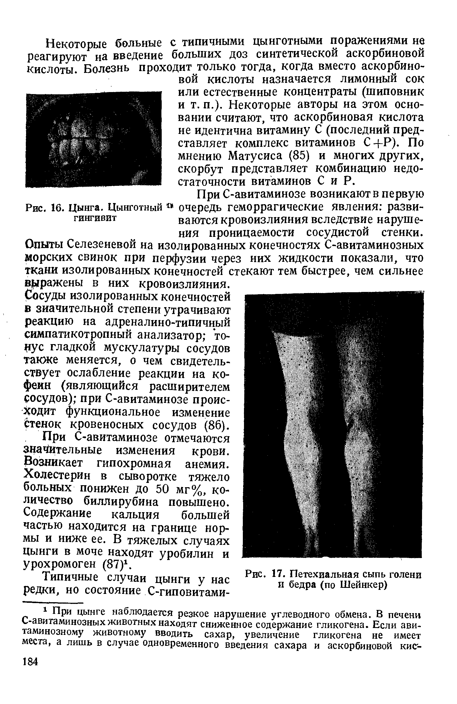 Рис. 16. Цынга. Цинготный очередь геморрагические явления разви-гингивит ваются кровоизлияния вследствие наруше-...