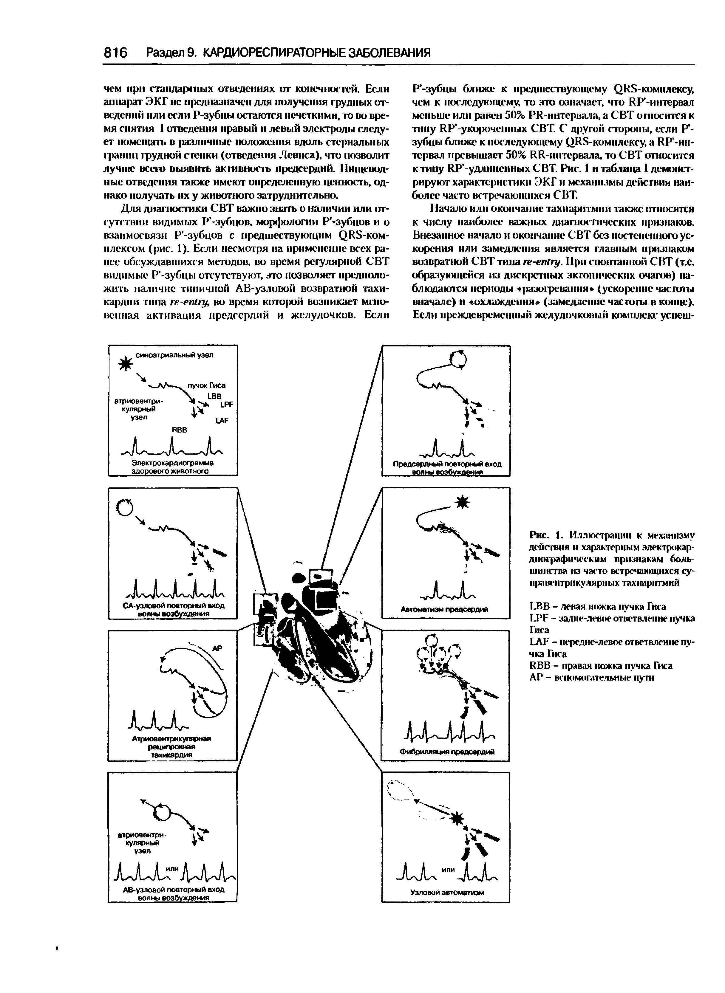 Рис. 1. Иллюстрации к механизму действия и характерным электрокардиографическим признакам большинства из часто встречающихся суправентрикулярных тахиаритмий...