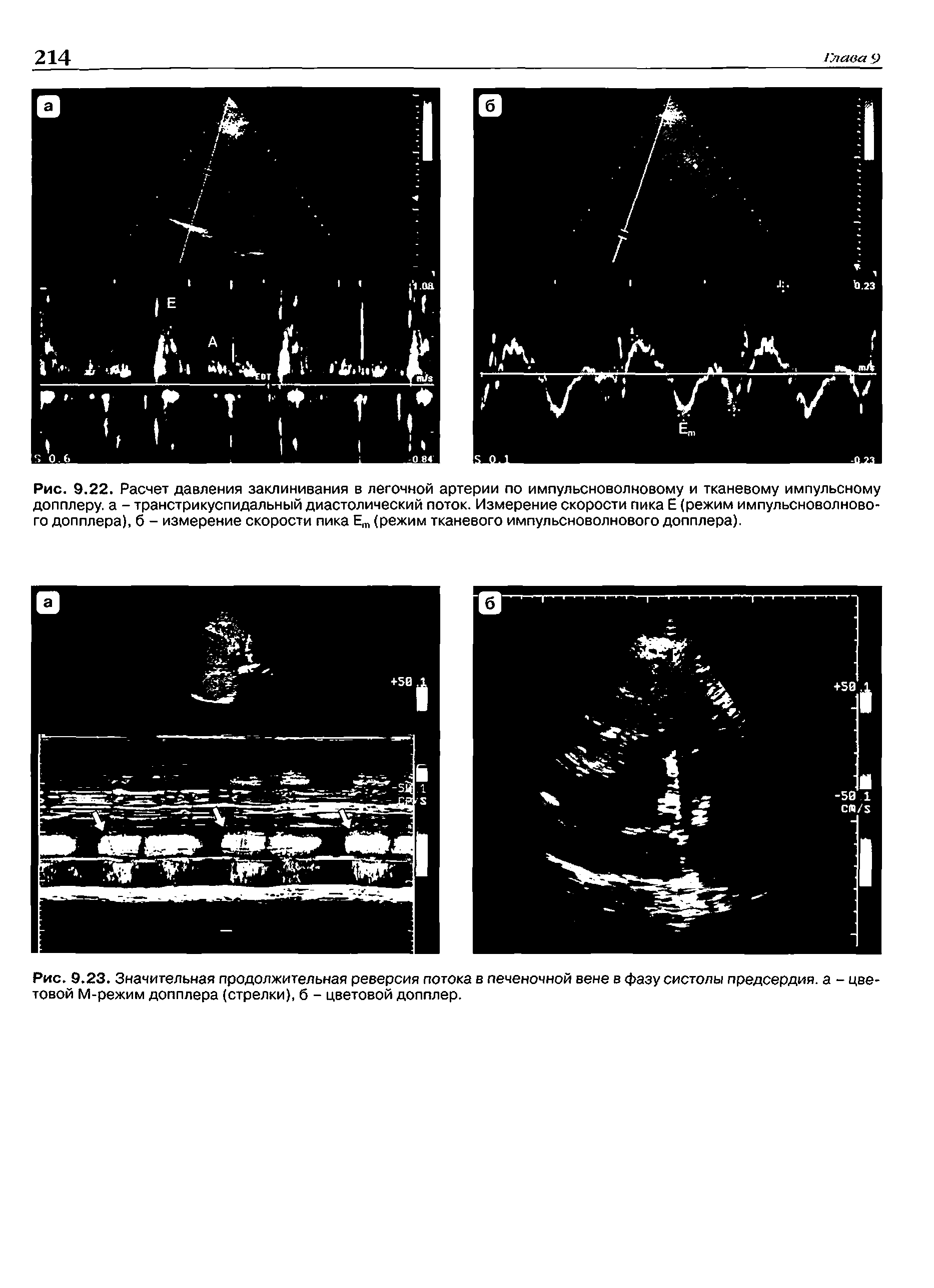 Рис. 9.23. Значительная продолжительная реверсия потока в печеночной вене в фазу систолы предсердия, а - две товой М-режим допплера (стрелки), б - цветовой допплер.