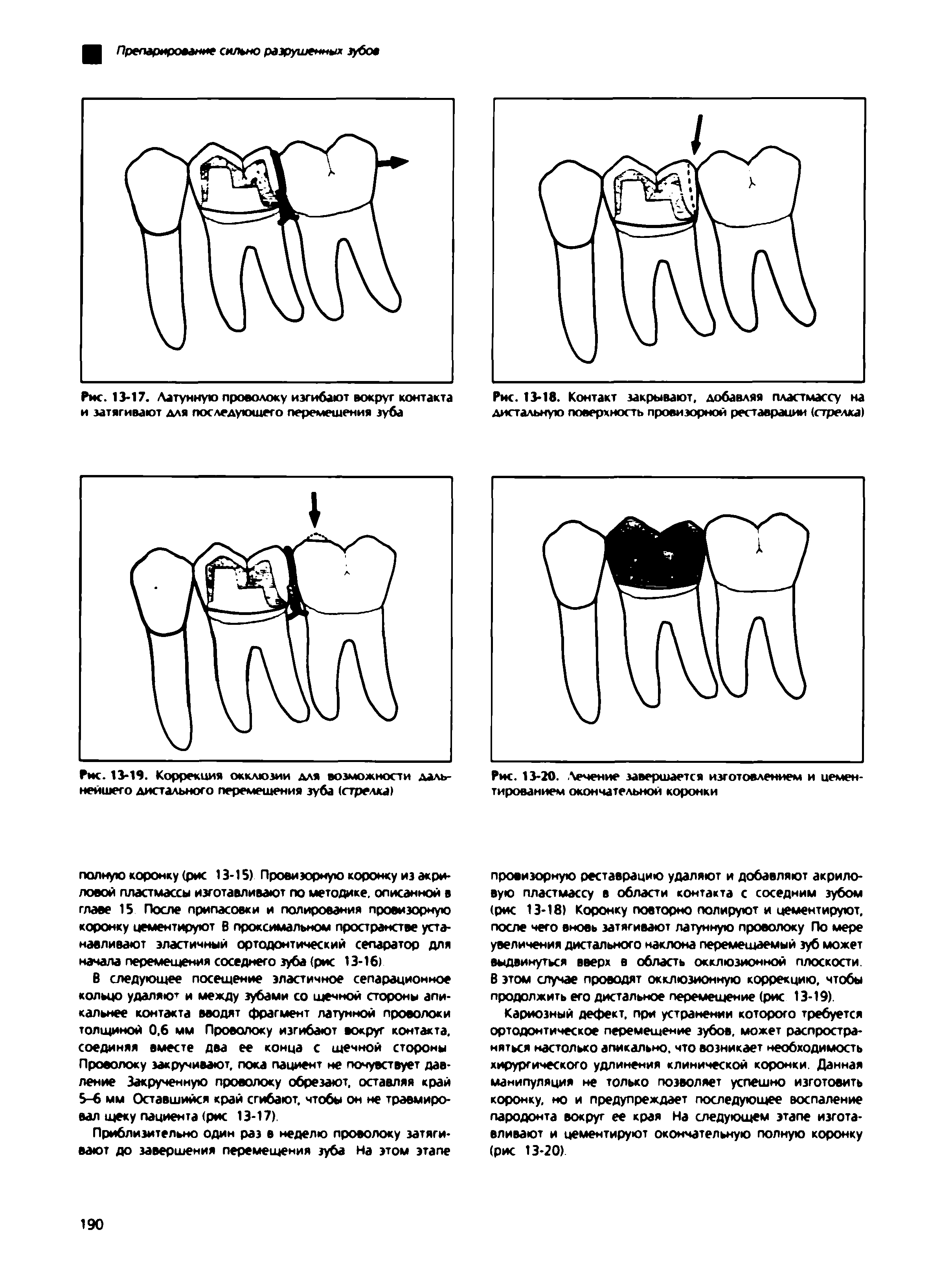 Рис. 13-18. Контакт закрывают, добавляя пластмассу на дистальную поверхность провизорной реставрации (стрелка)...