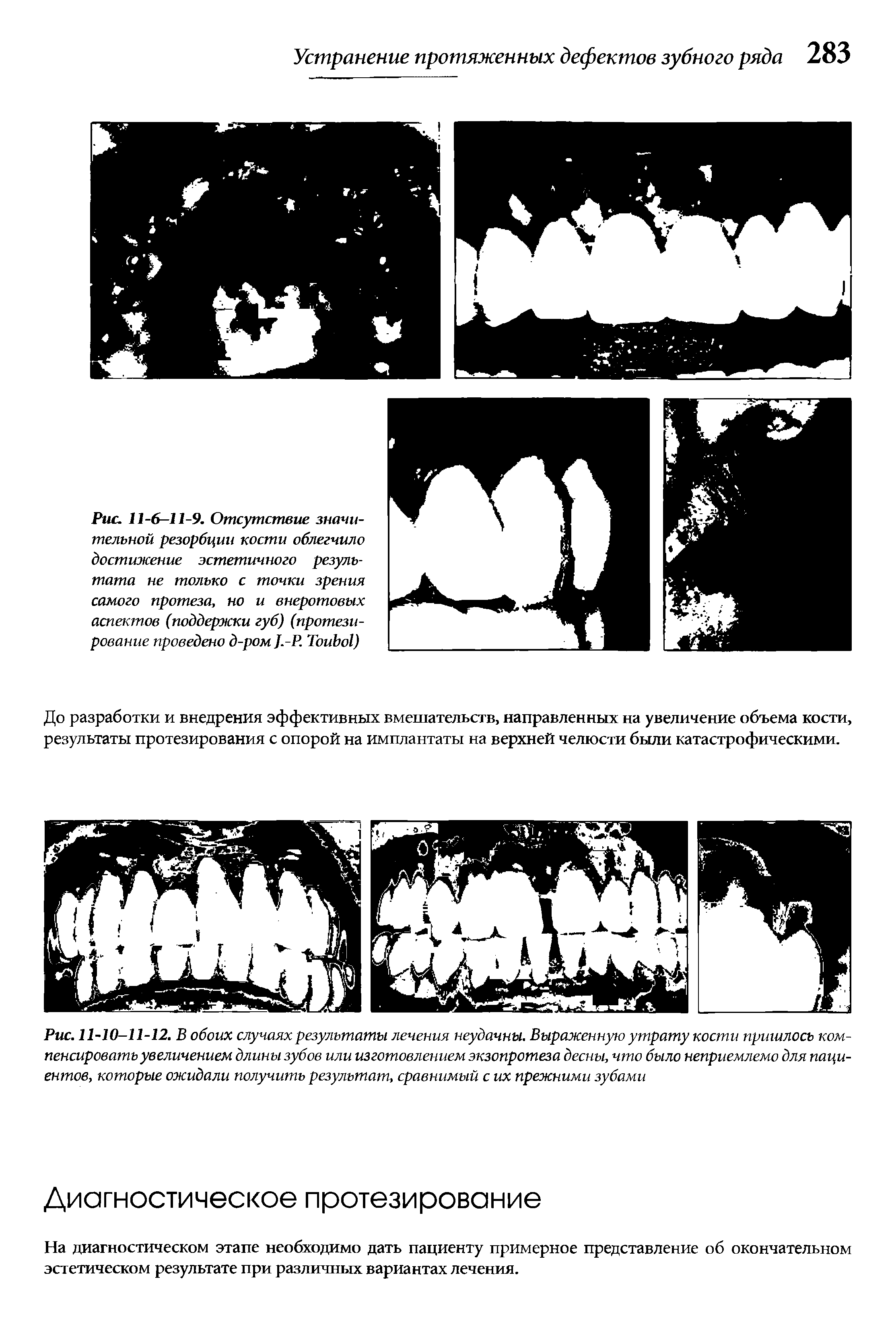 Рис. 11-10-11-12. В обоих случаях результаты лечения неудачны. Выраженную утрату кости пришлось компенсировать увеличением длины зубов или изготовлением экзопротеза десны, что было неприемлемо для пациентов, которые ожидали получить результат, сравнимый с их прежними зубами...