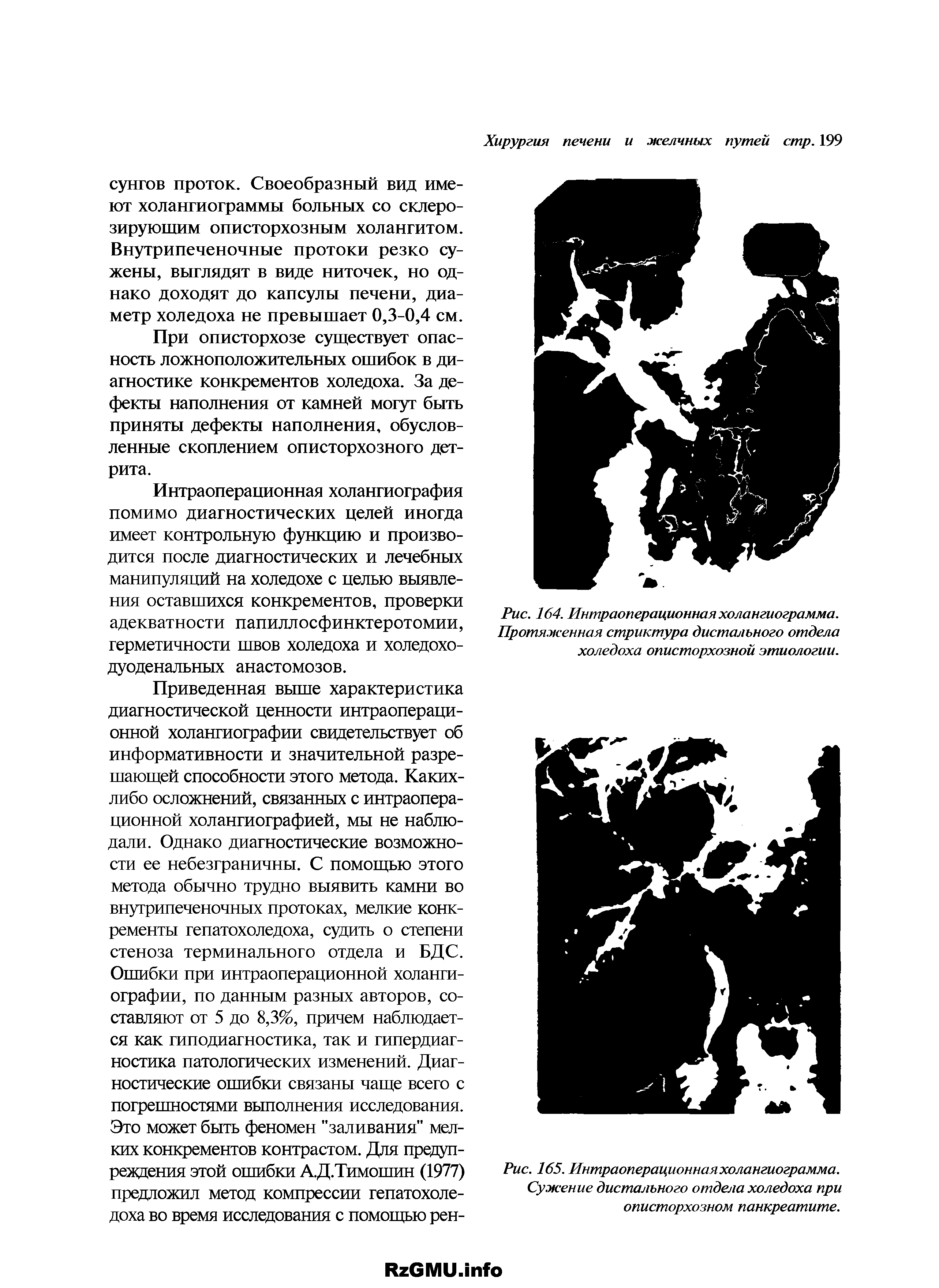 Рис. 164. Интраоперационная холангиограмма. Протяженная стриктура дистального отдела холедоха описторхозной этиологии.