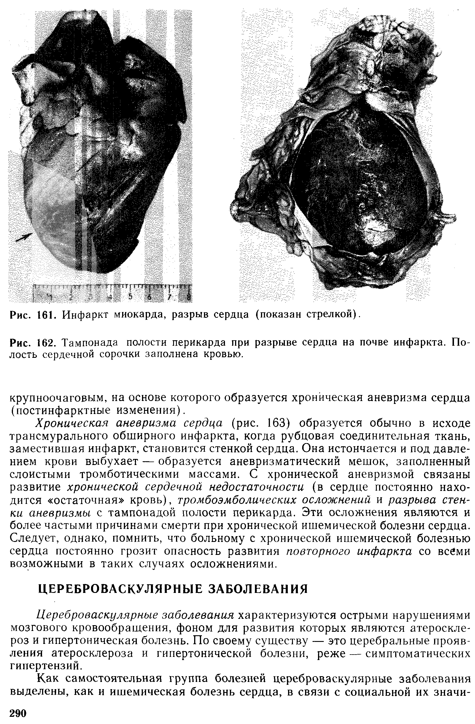 Рис. 162. Тампонада полости перикарда при разрыве сердца на почве инфаркта. Полость сердечной сорочки заполнена кровью.