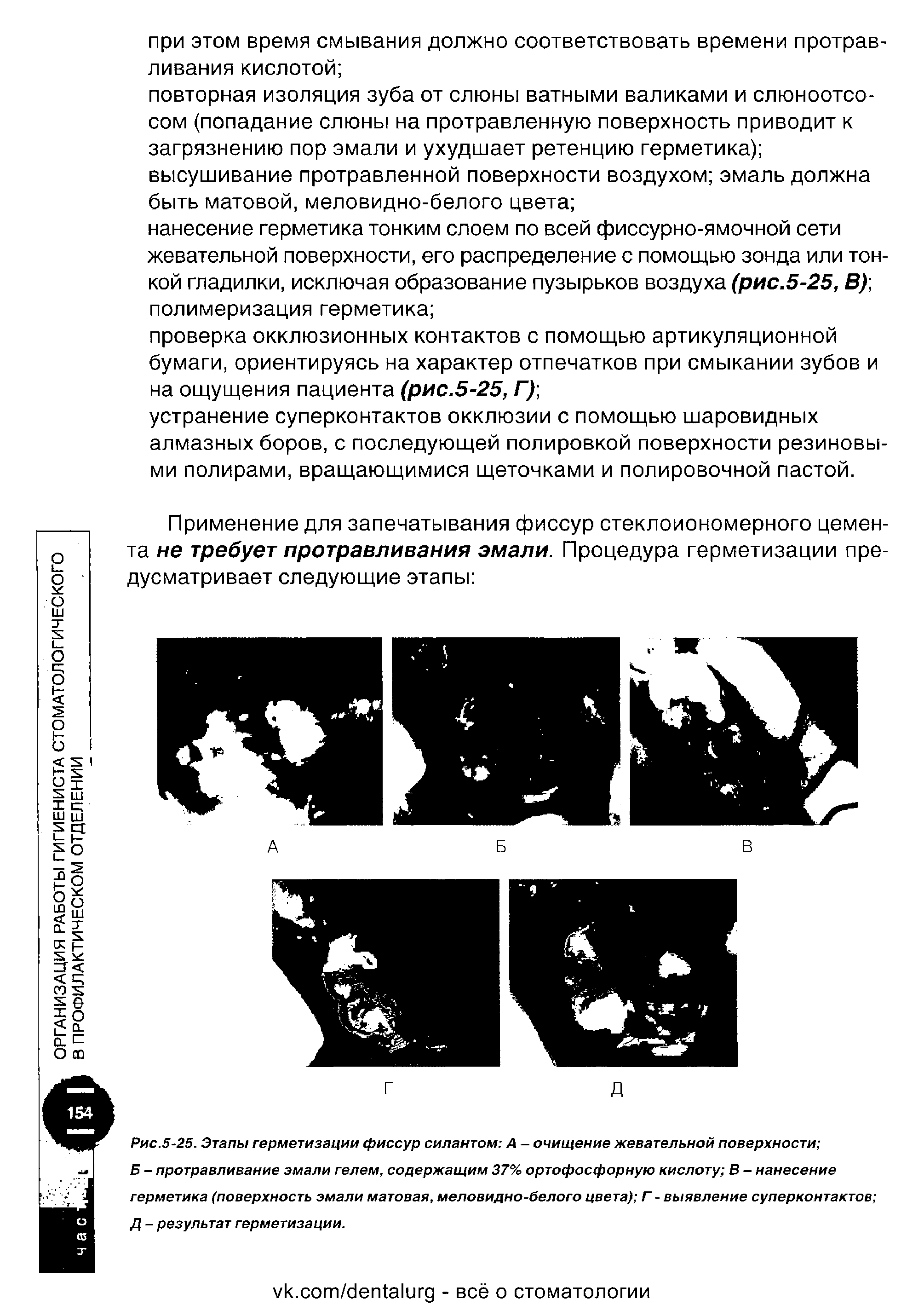 Рис.5-25. Этапы герметизации фиссур силантом А - очищение жевательной поверхности ...