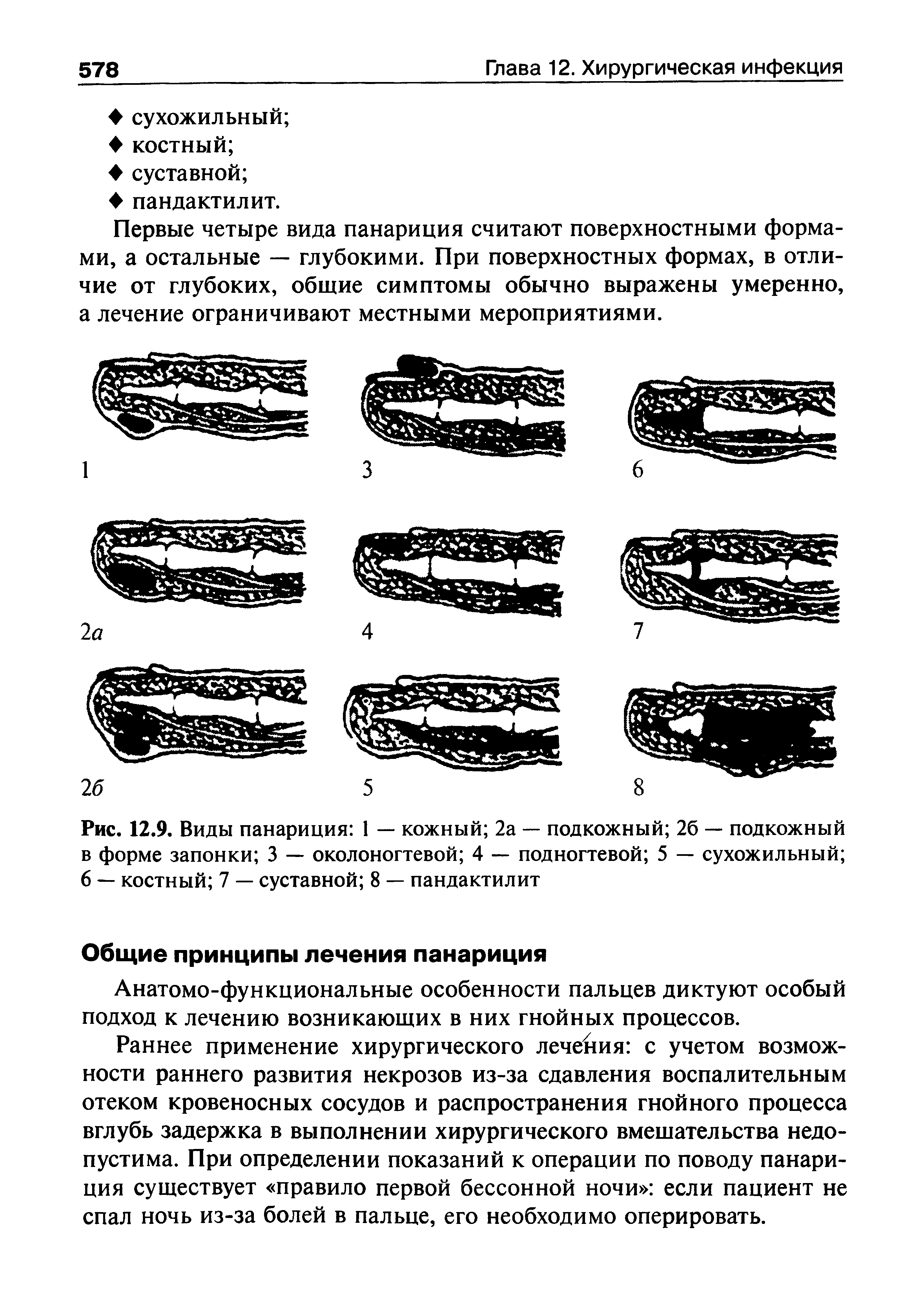 Рис. 12.9. Виды панариция 1 — кожный 2а — подкожный 26 — подкожный в форме запонки 3 — околоногтевой 4 — под ногтевой 5 — сухожильный 6 — костный 7 — суставной 8 — пандактилит...