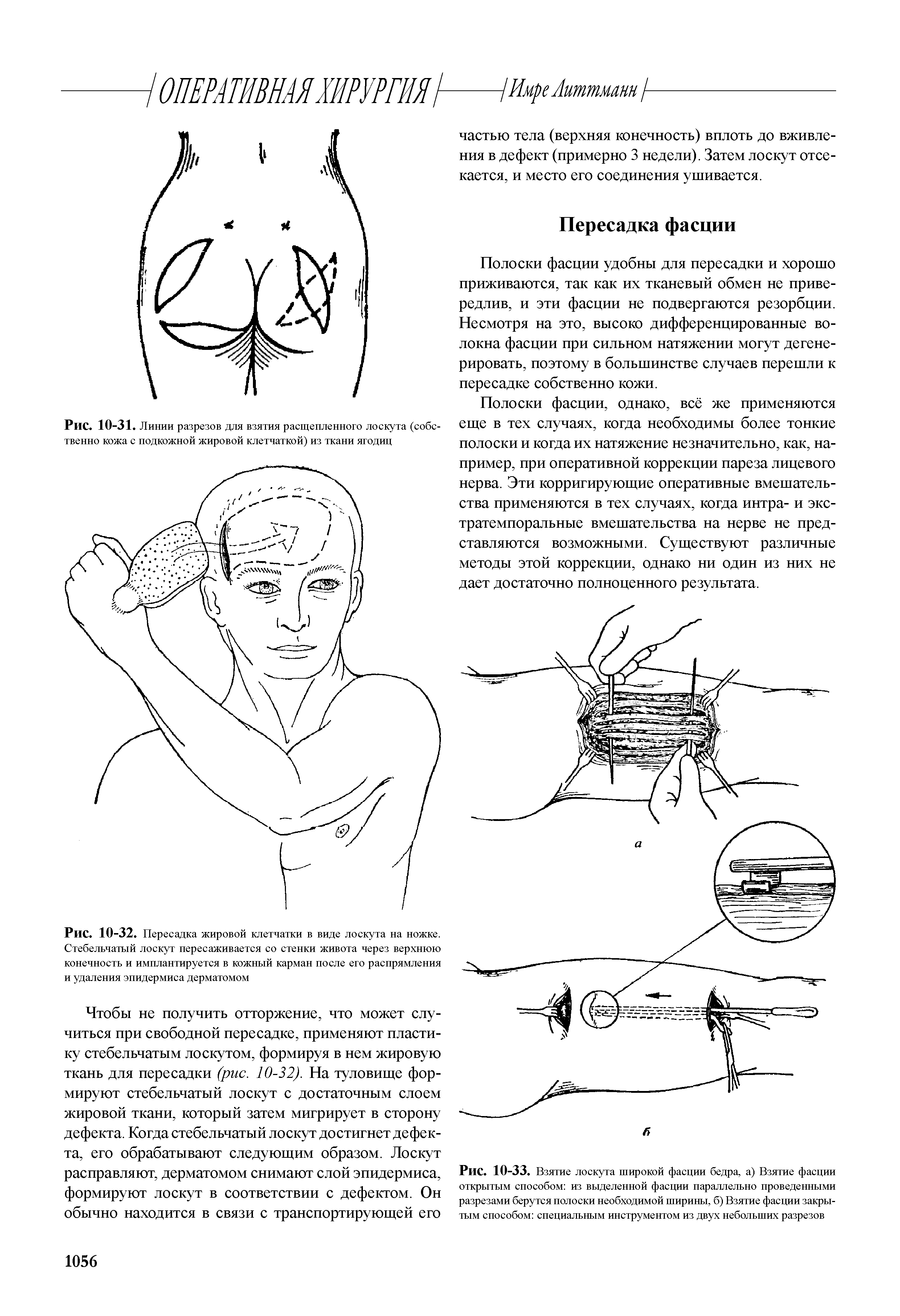 Рис. 10-32. Пересадка жировой клетчатки в виде лоскута на ножке. Стебельчатый лоскут пересаживается со стенки живота через верхнюю конечность и имплантируется в кожный карман после его распрямления...