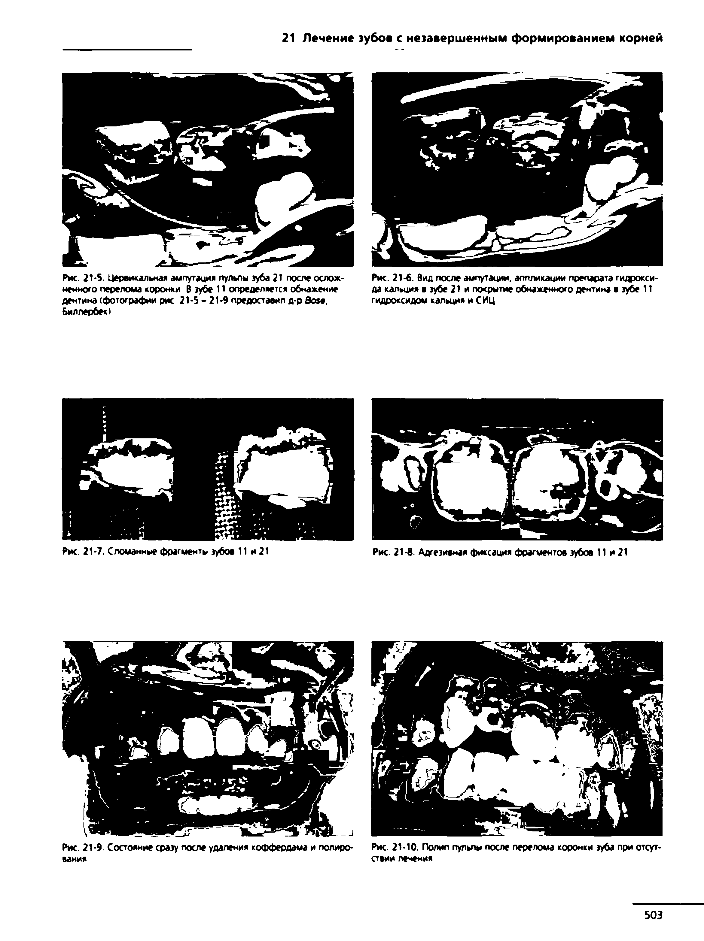 Рис. 21-6. Вид после ампутации, аппликации препарата гидроксида кальция в зубе 21 и покрытие обнаженного дентина в зубе 11 гидроксидом кальция и С ИЦ...