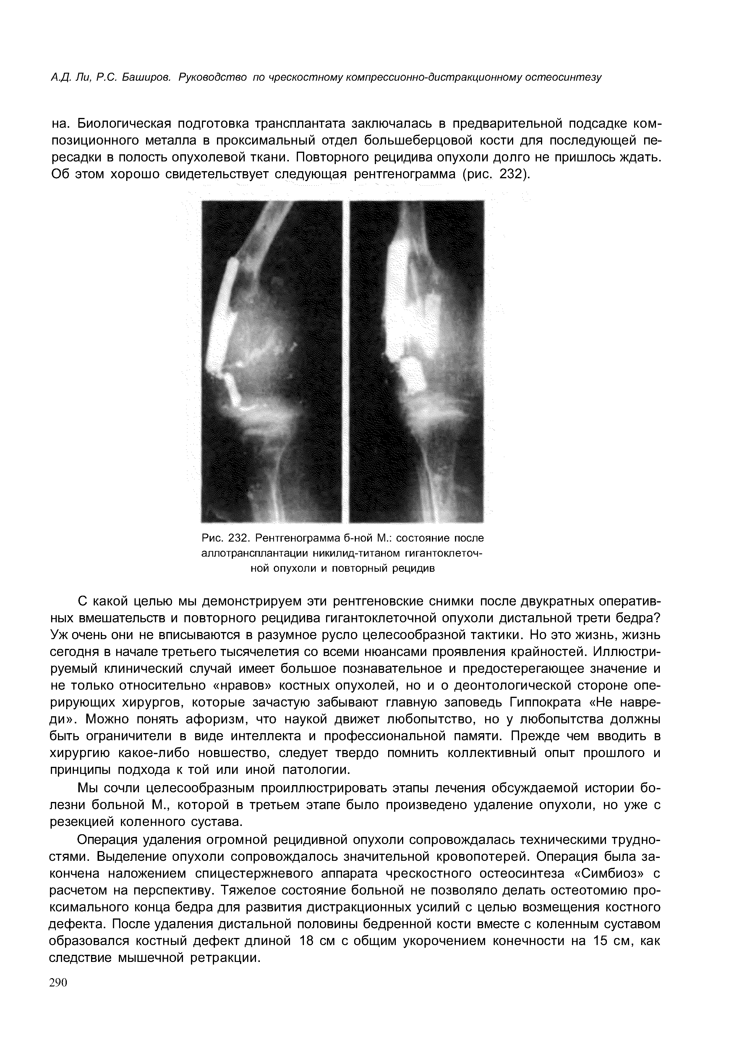 Рис. 232. Рентгенограмма б-ной М. состояние после аллотрансплантации никилид-титаном гигантоклеточной опухоли и повторный рецидив...