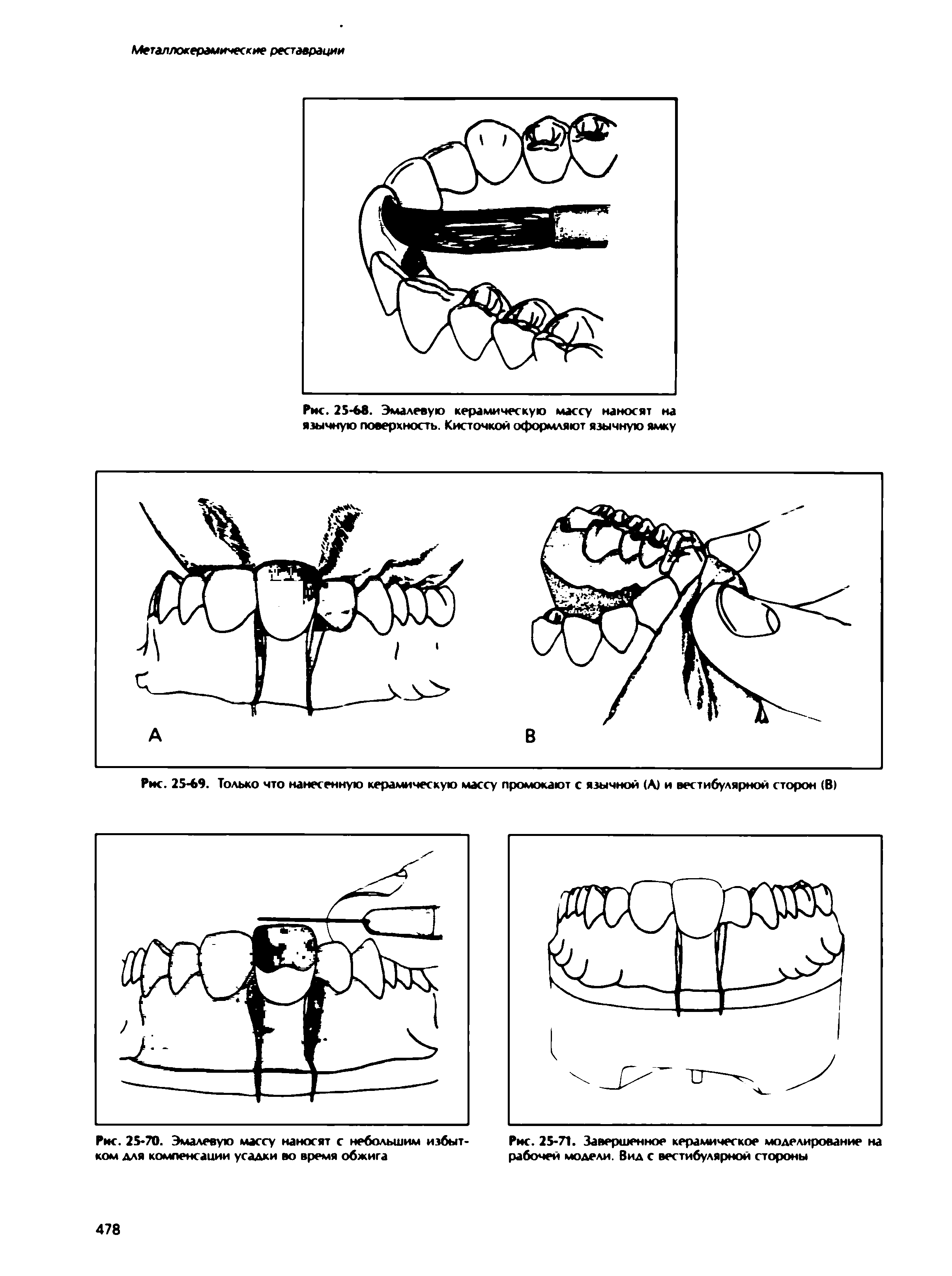 Рис. 25-69. Только что нанесенную керамическую массу промокают с язычной (А) и вестибулярной сторон (В)...