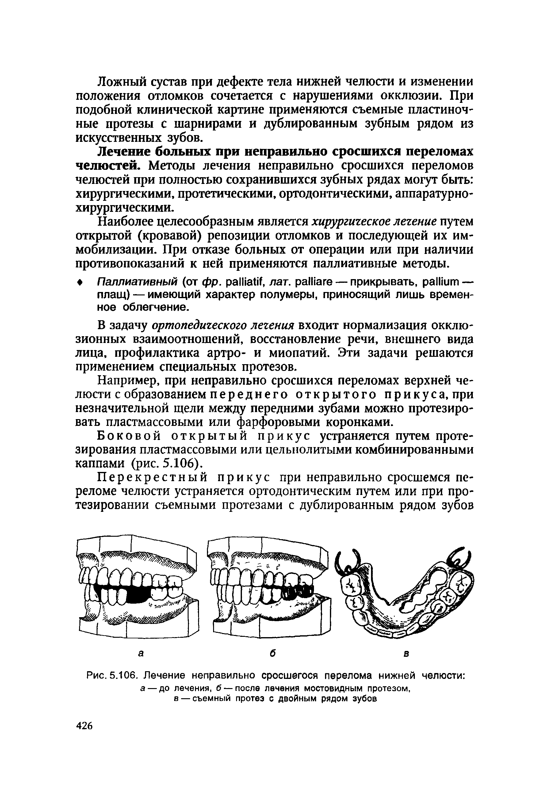 Рис. 5.106. Лечение неправильно сросшегося перелома нижней челюсти а — до лечения, б — после лечения мостовидным протезом, в — съемный протез с двойным рядом зубов...