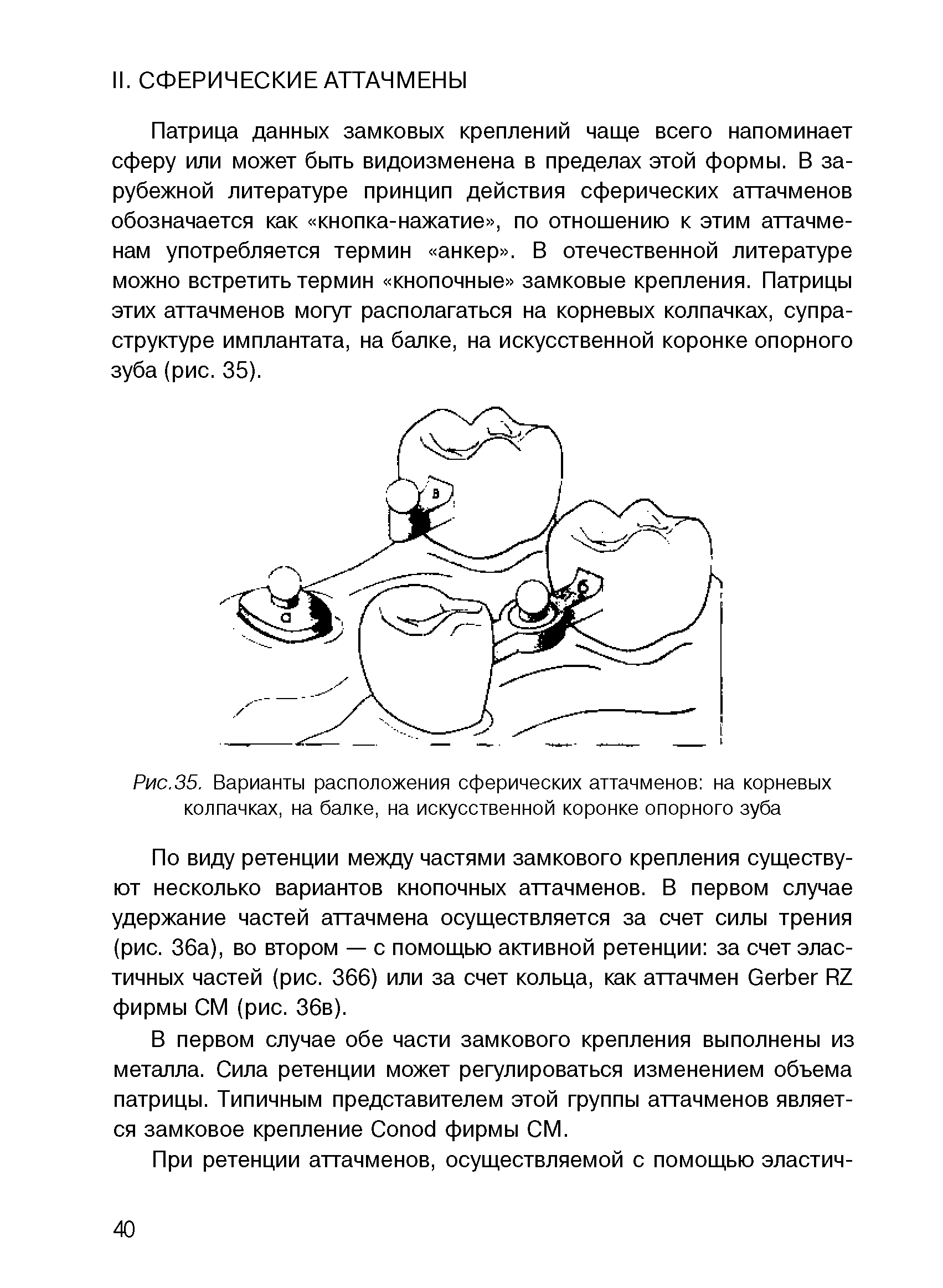 Рис.35. Варианты расположения сферических аттачменов на корневых колпачках, на балке, на искусственной коронке опорного зуба...