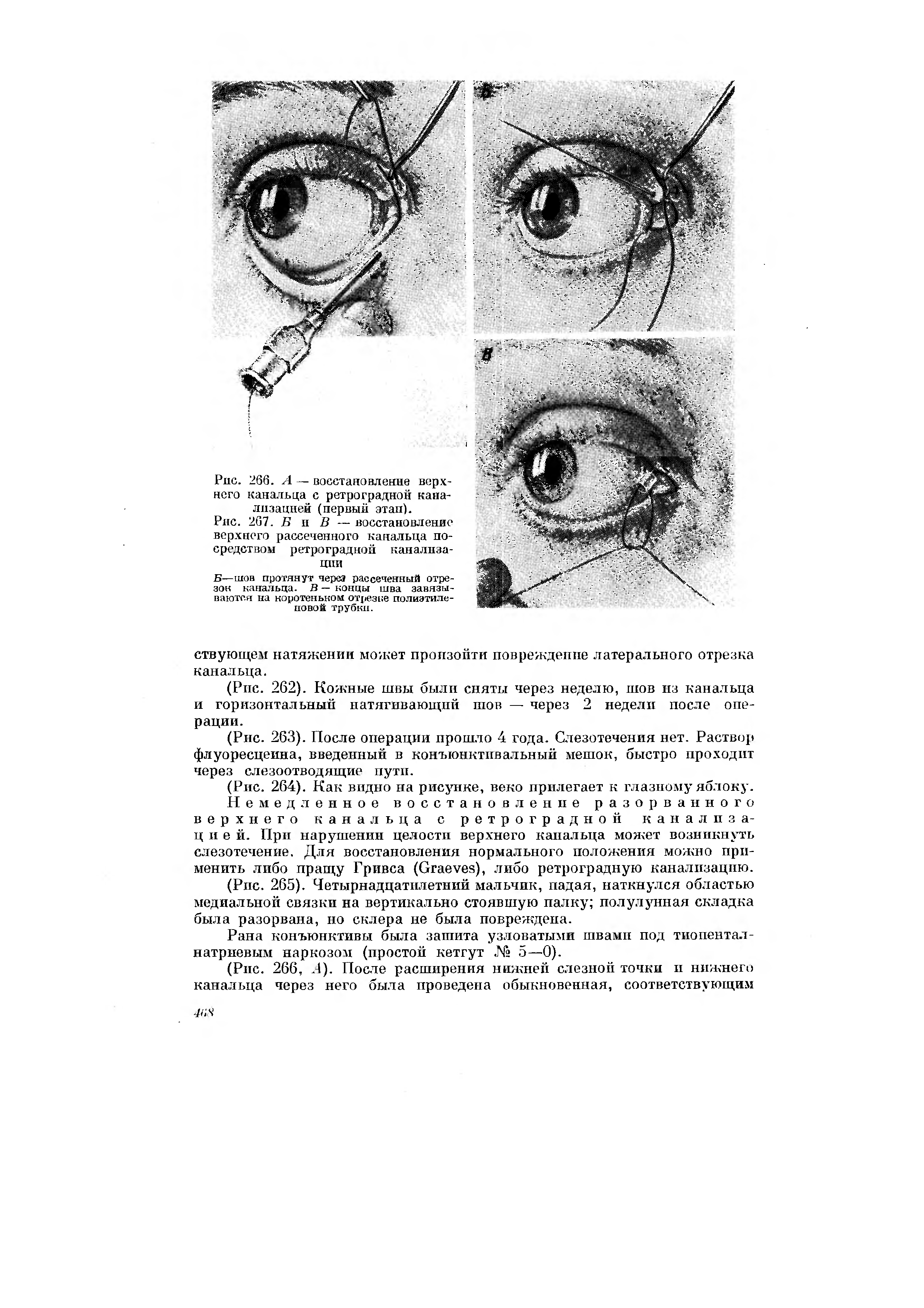 Рис. 267. В п В — восстановление верхнего рассеченного канальца посредством ретроградной канализации...