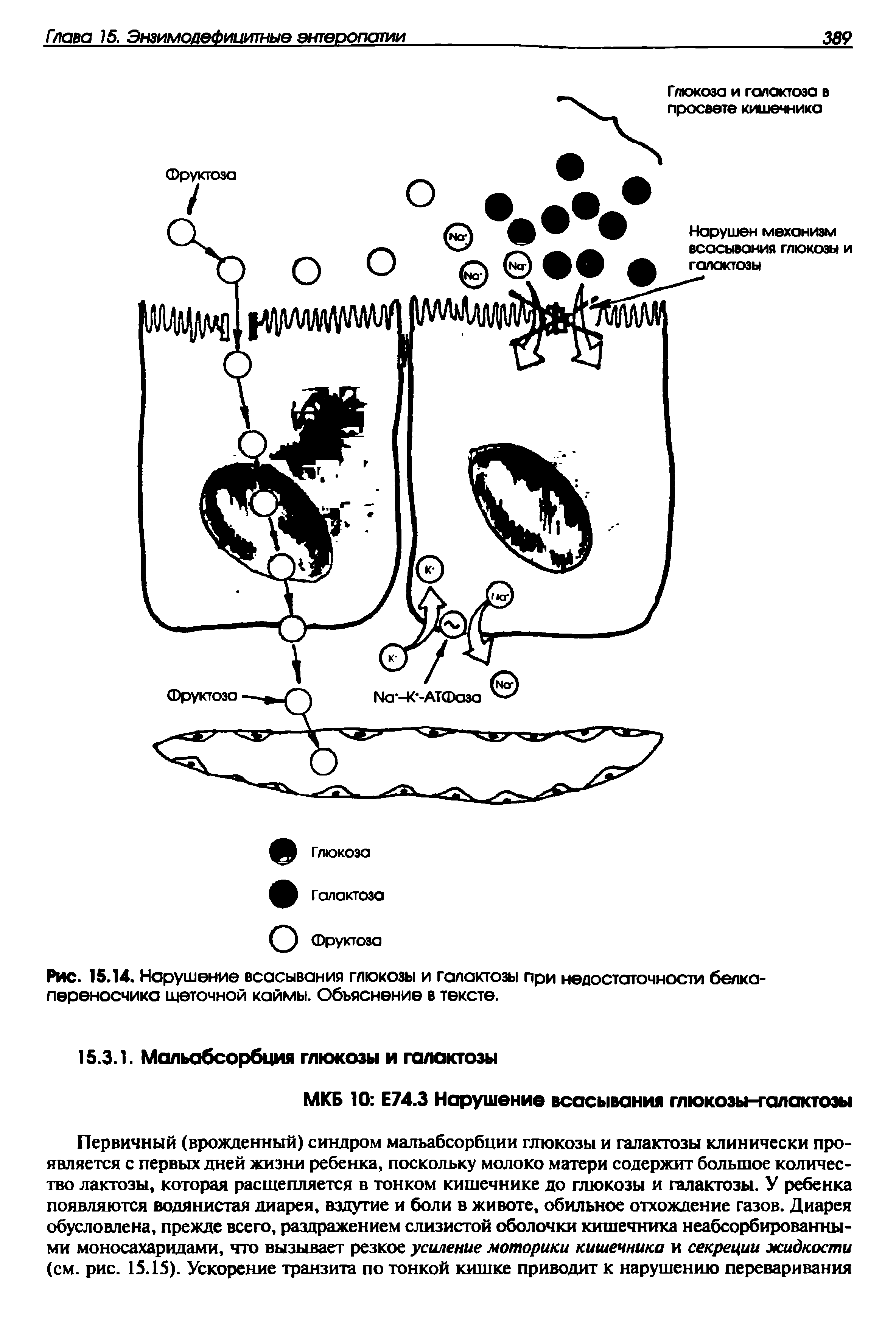 Рис. 15.14. Нарушение всасывания глюкозы и галактозы при недостаточности белка-переносчика щеточной каймы. Объяснение в тексте.