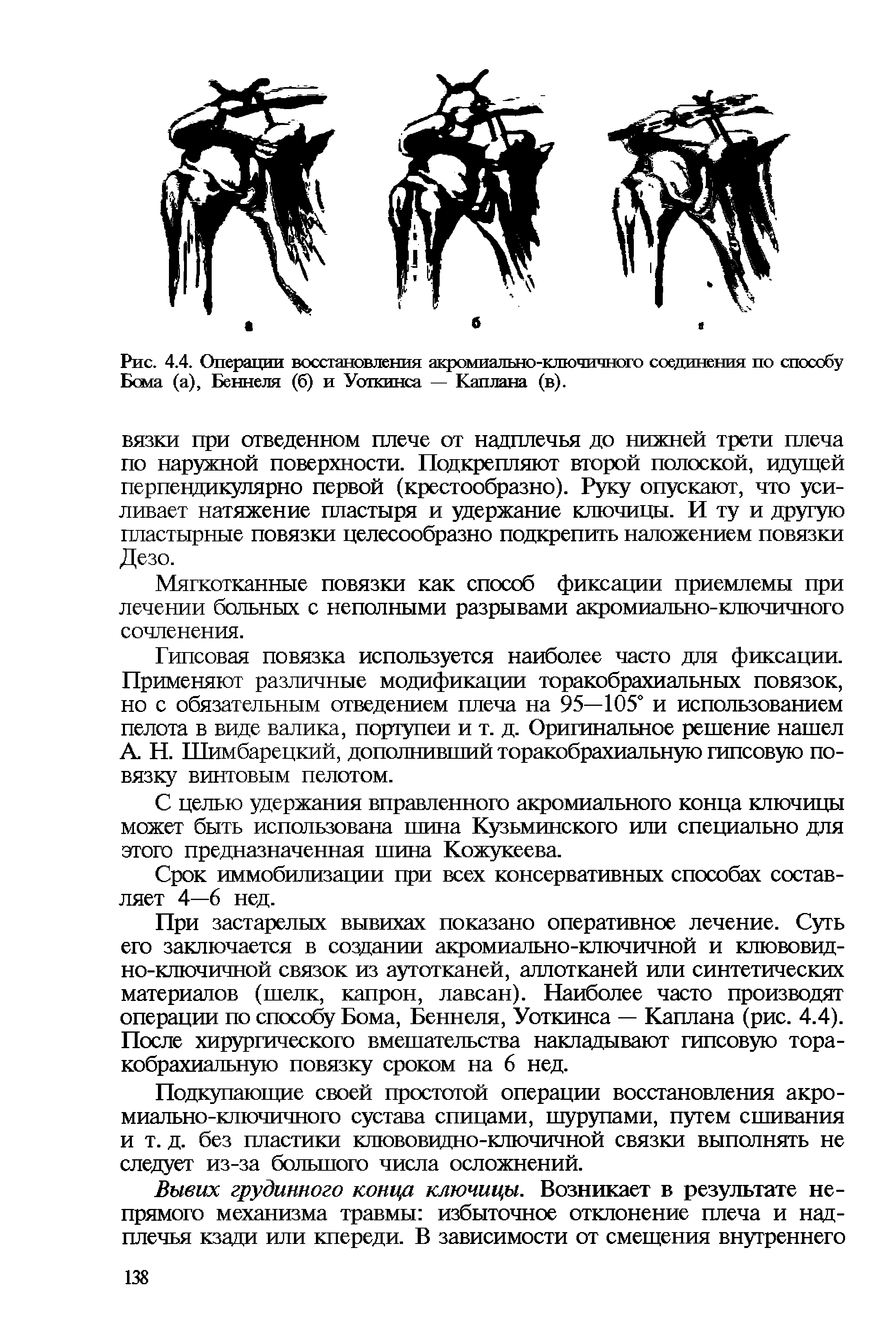 Рис. 4.4. Операции восстановления акромиально-ключичного соединения по способу Бема (а), Беннеля (б) и Уоткинса — Каплана (в).