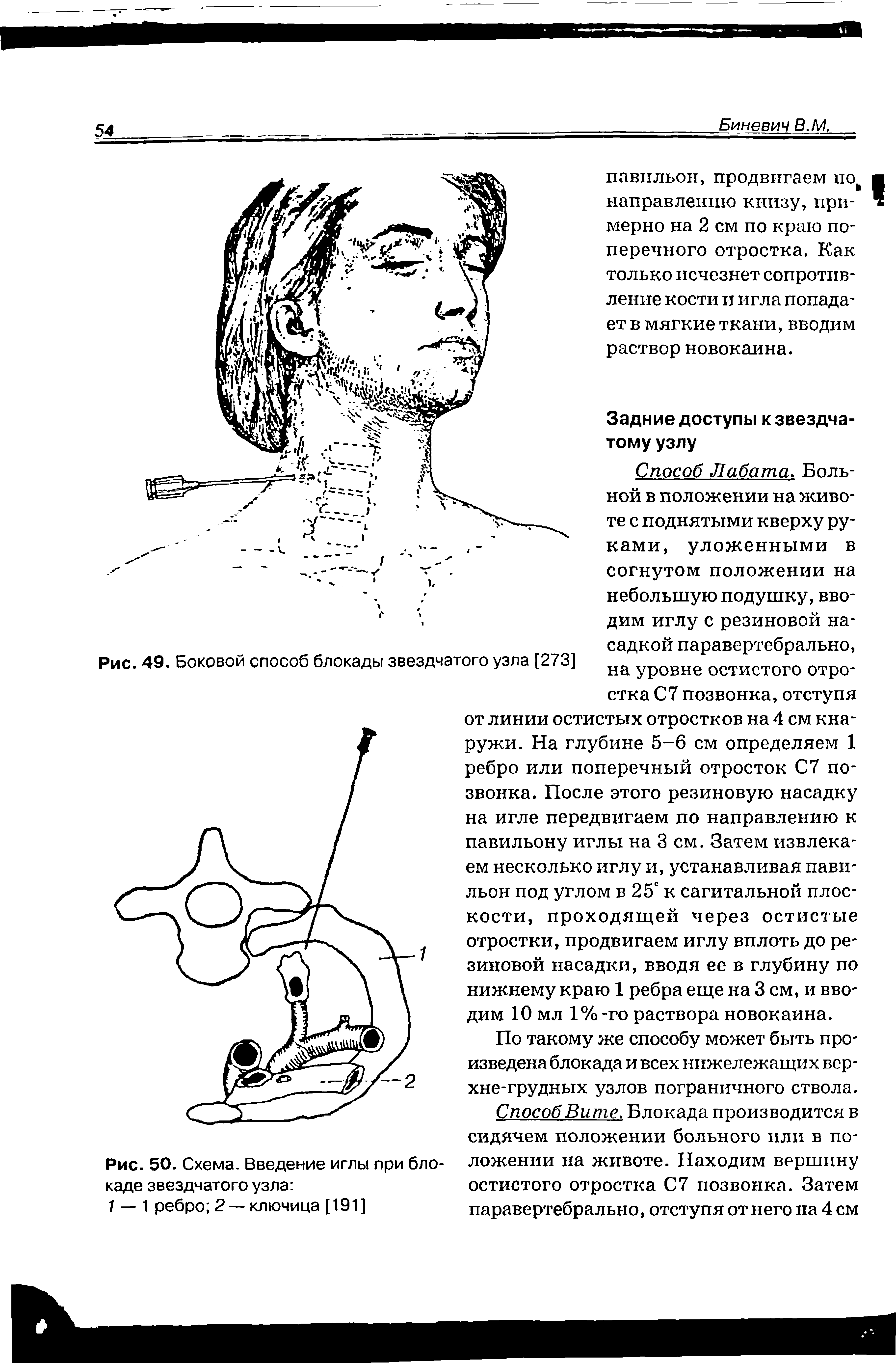 Рис. 50. Схема. Введение иглы при блокаде звездчатого узла ...