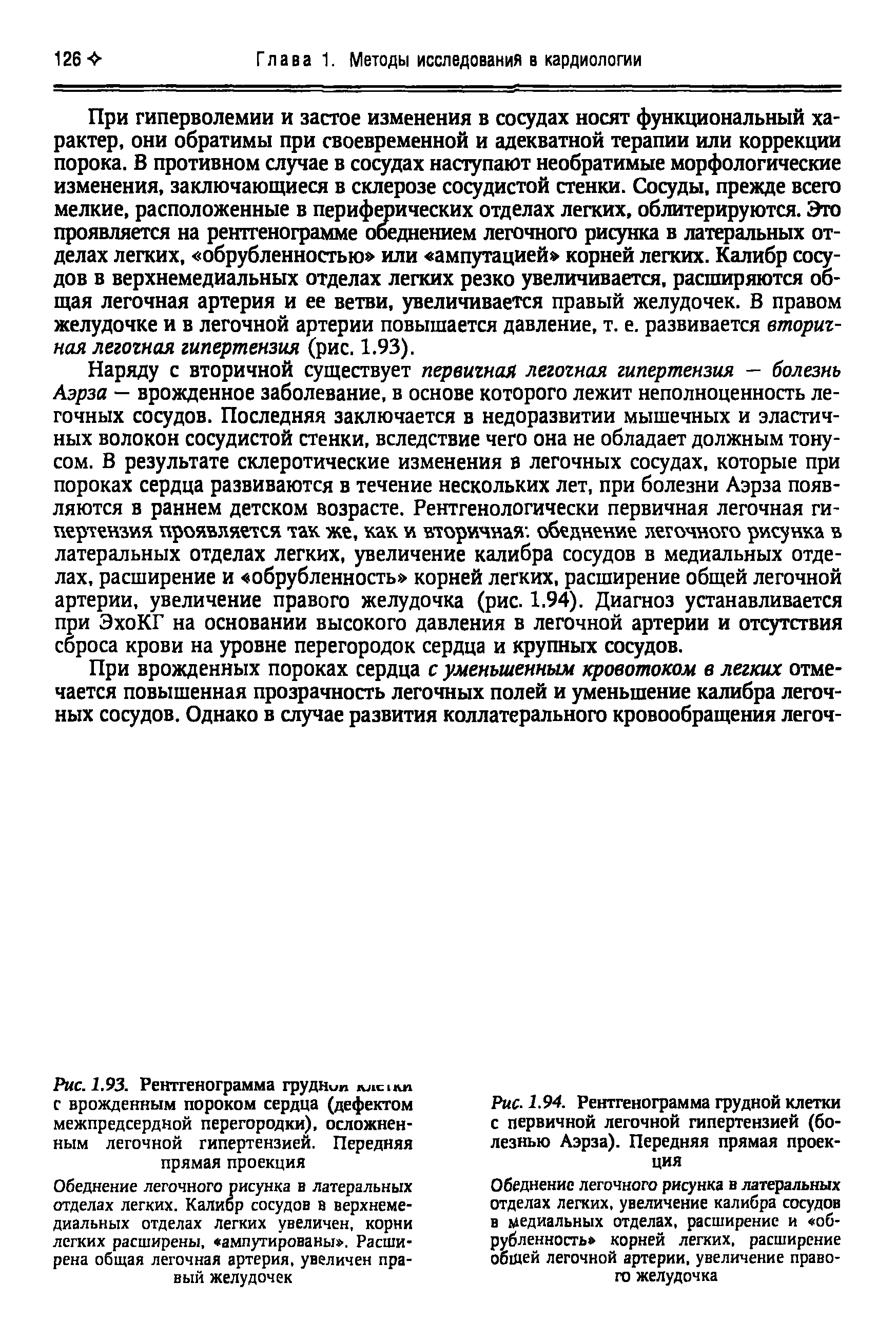 Рис. 1.94. Рентгенограмма грудной клетки с первичной легочной гипертензией (болезнью Аэрза). Передняя прямая проекция...