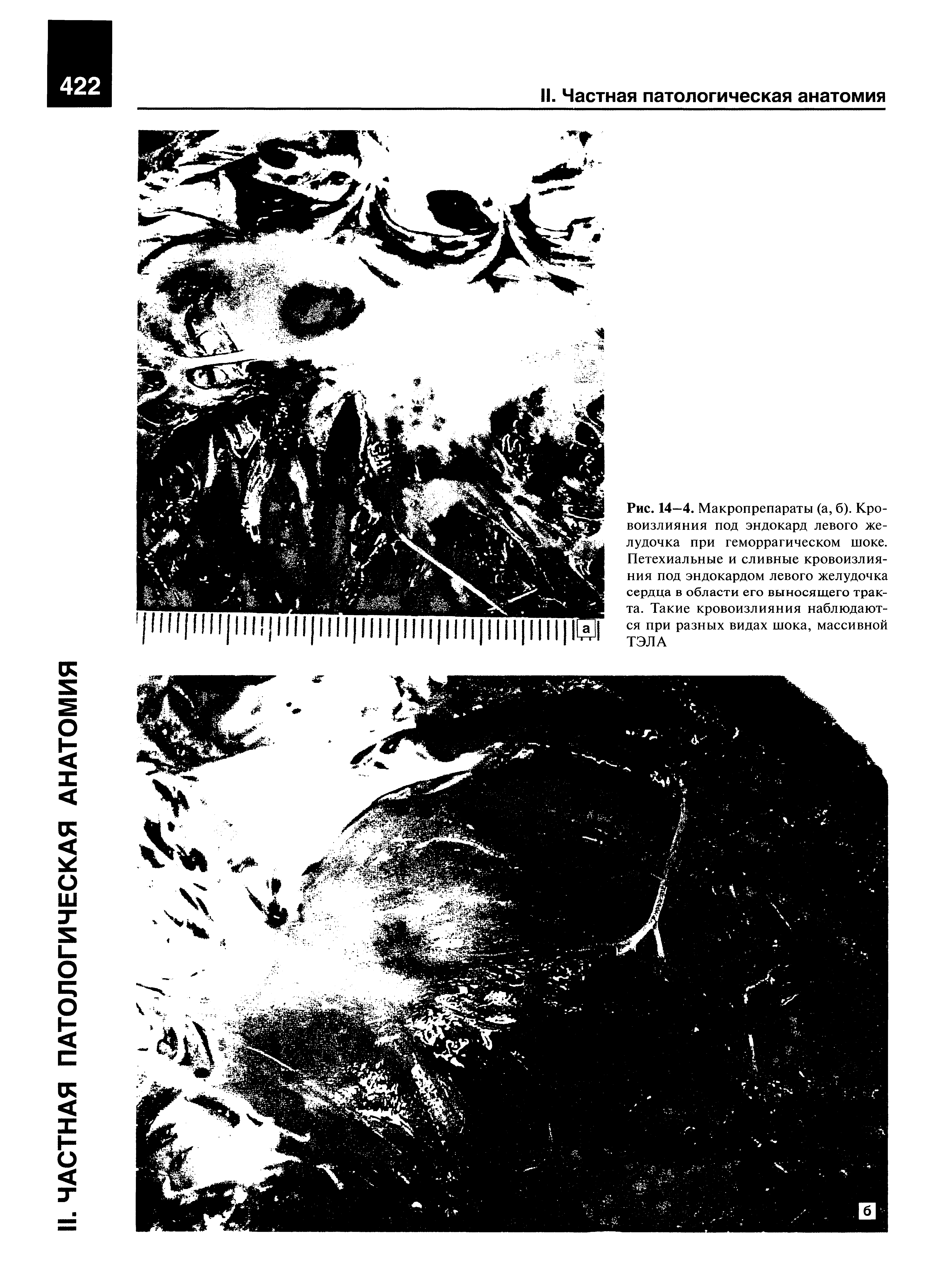 Рис. 14—4. Макропрепараты (а, б). Кровоизлияния под эндокард левого желудочка при геморрагическом шоке. Петехиальные и сливные кровоизлияния под эндокардом левого желудочка сердца в области его выносящего тракта. Такие кровоизлияния наблюдаются при разных видах шока, массивной ТЭЛА...