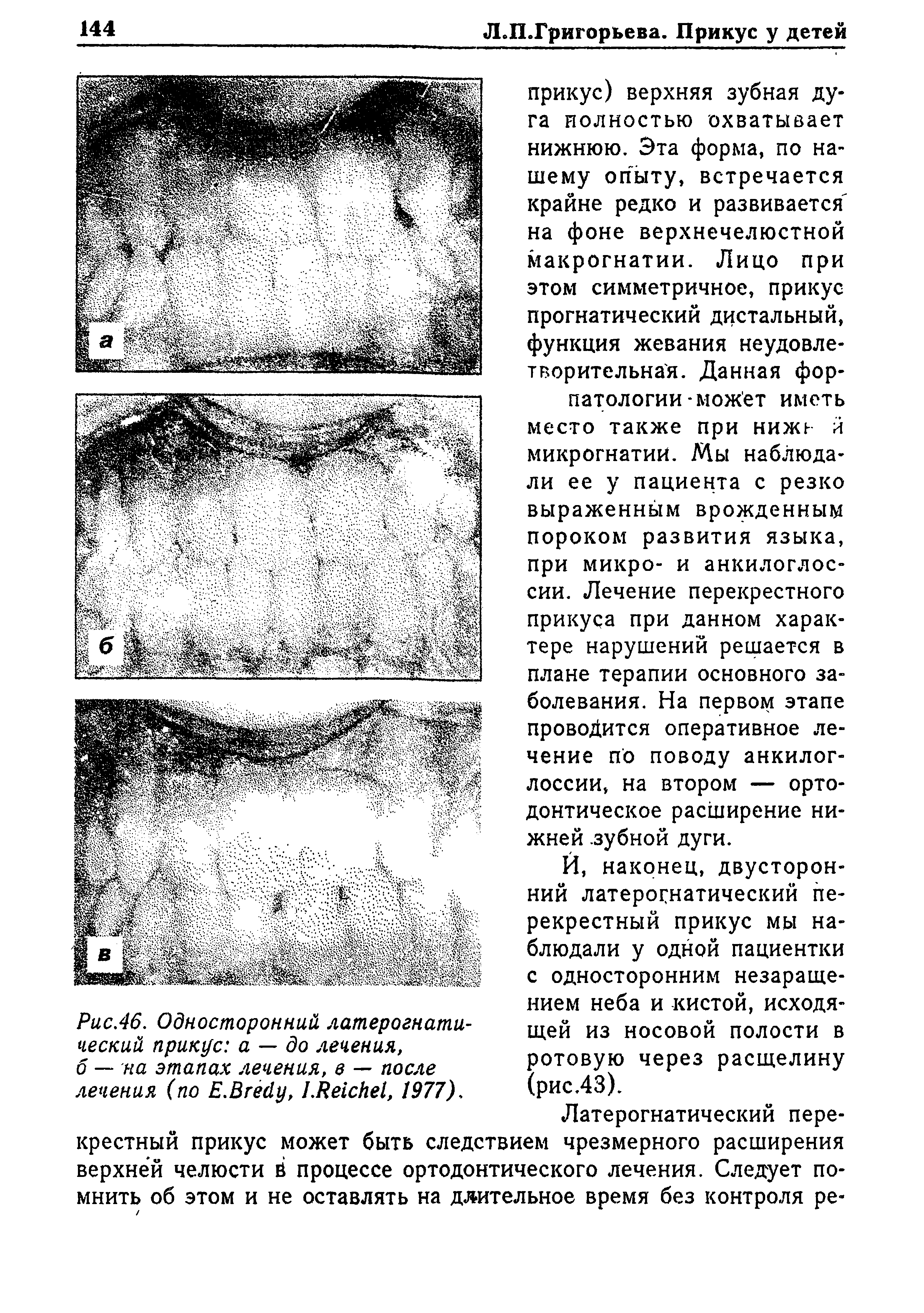 Рис.46. Односторонний латерогнати-ческий прикус а — до лечения, б — на этапах лечения, в — после лечения (по Е.Вгейу, 1.Ре1сНе1, 1977).