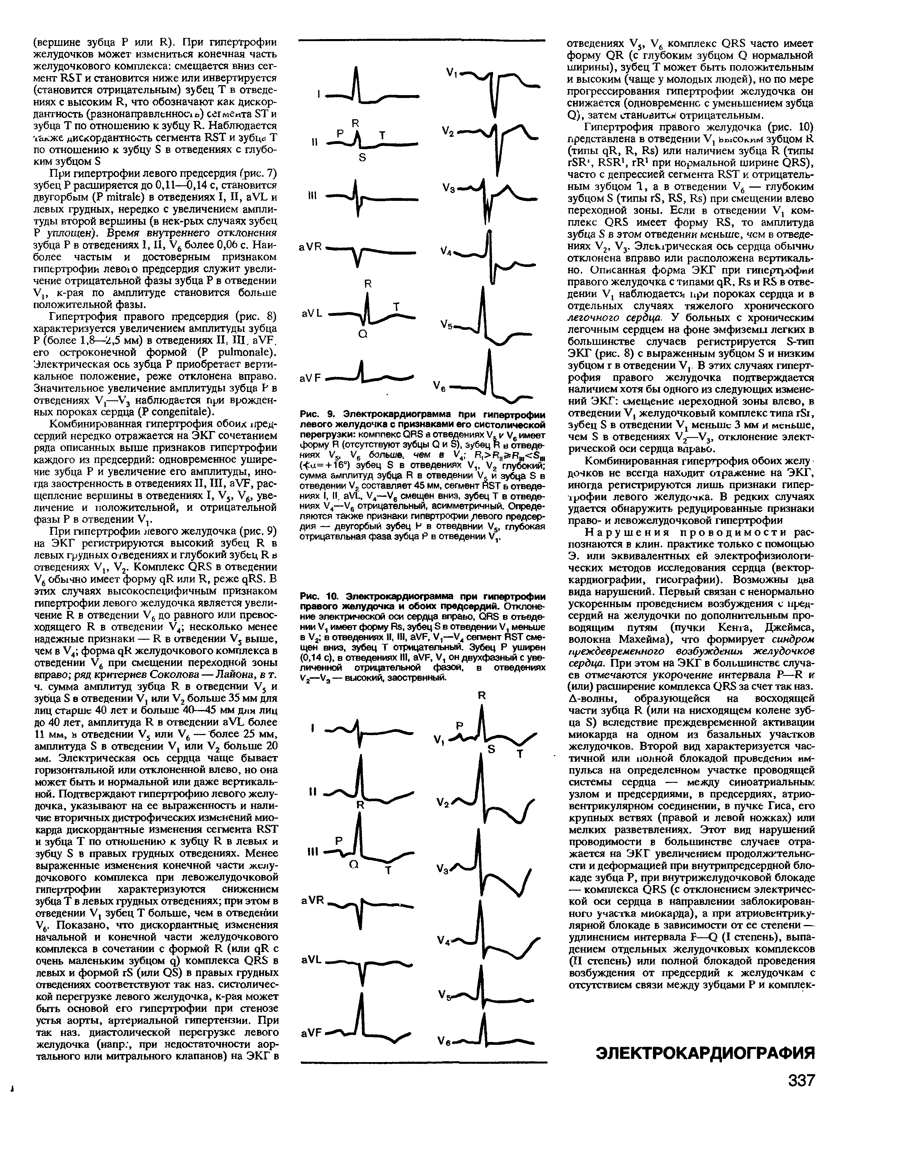 Рис. 10. Электрокардиограмма при гипертрофии правого желудочка и обоих предсердий. Отклонение электрической оси сердца вправо, QRS в отведении V, имеет форму R , зубец S в отведении V, меньше в V2 в отведениях II, III, VF, V,—V4 сегмент RST смещен вниз, зубец Т отрицательный. Зубец Р уширен (0,14 с), в отведениях III, VF, V, он двухфазный с увеличенной отрицательной фазой, в отведениях V2—V3 — высокий, заострвнный.