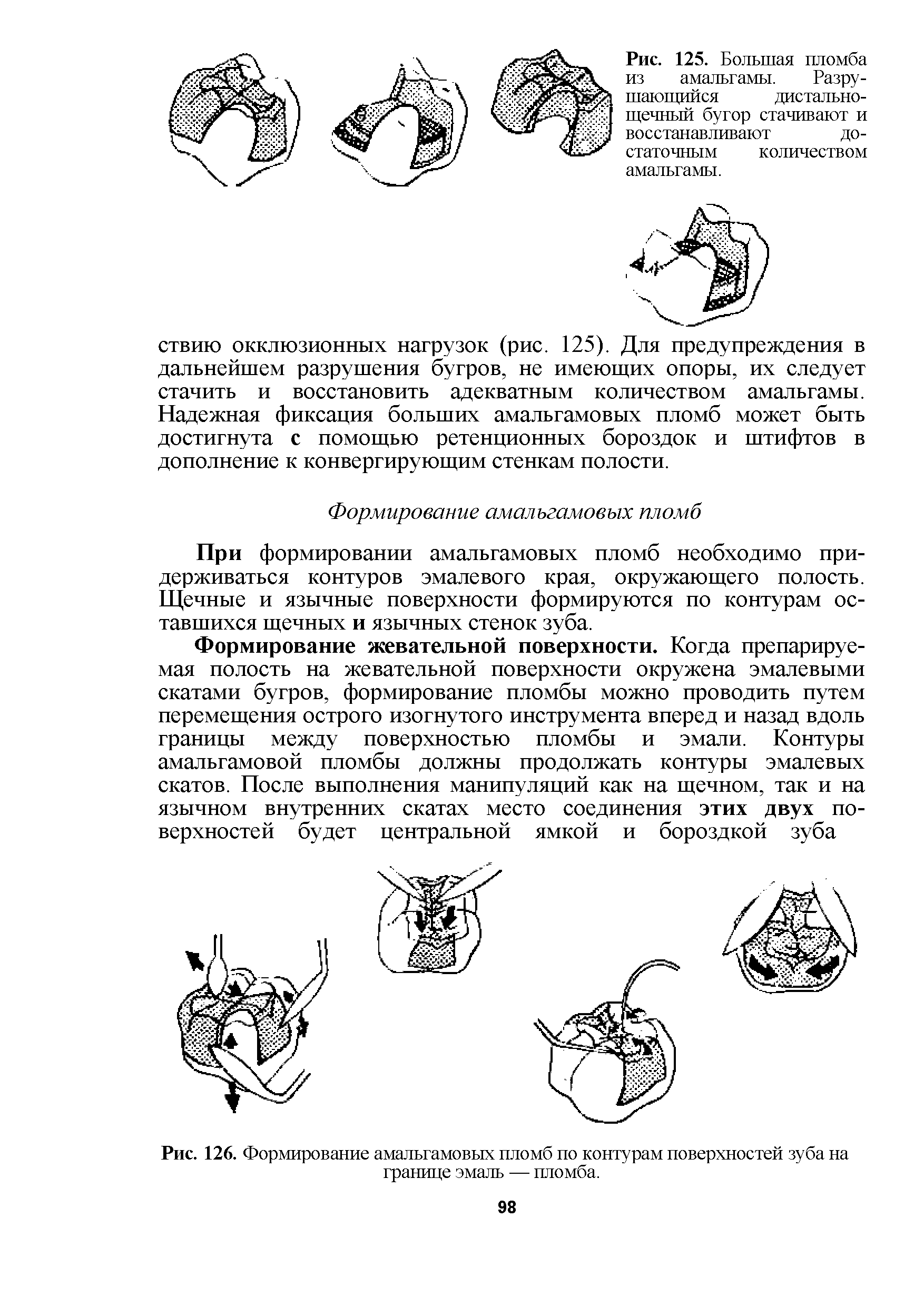 Рис. 126. Формирование амальгамовых пломб по контурам поверхностей зуба на границе эмаль — пломба.