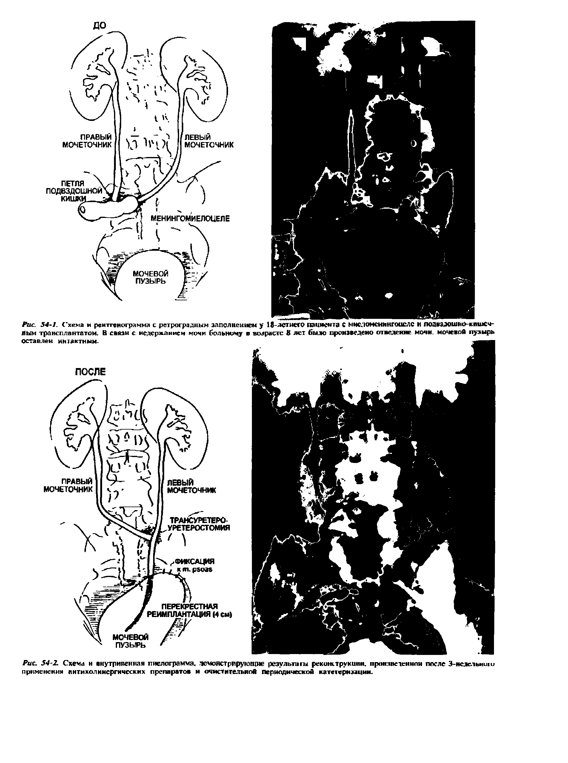 Рис. 54-2. Схема н внутривенная пиелограмма,. тсмонстрпрукэщие результаты рекожтрукиии. произведенной после З-нсэельмши применения антихолиисргических препаратов и очистительнпА периодической катетеризации.