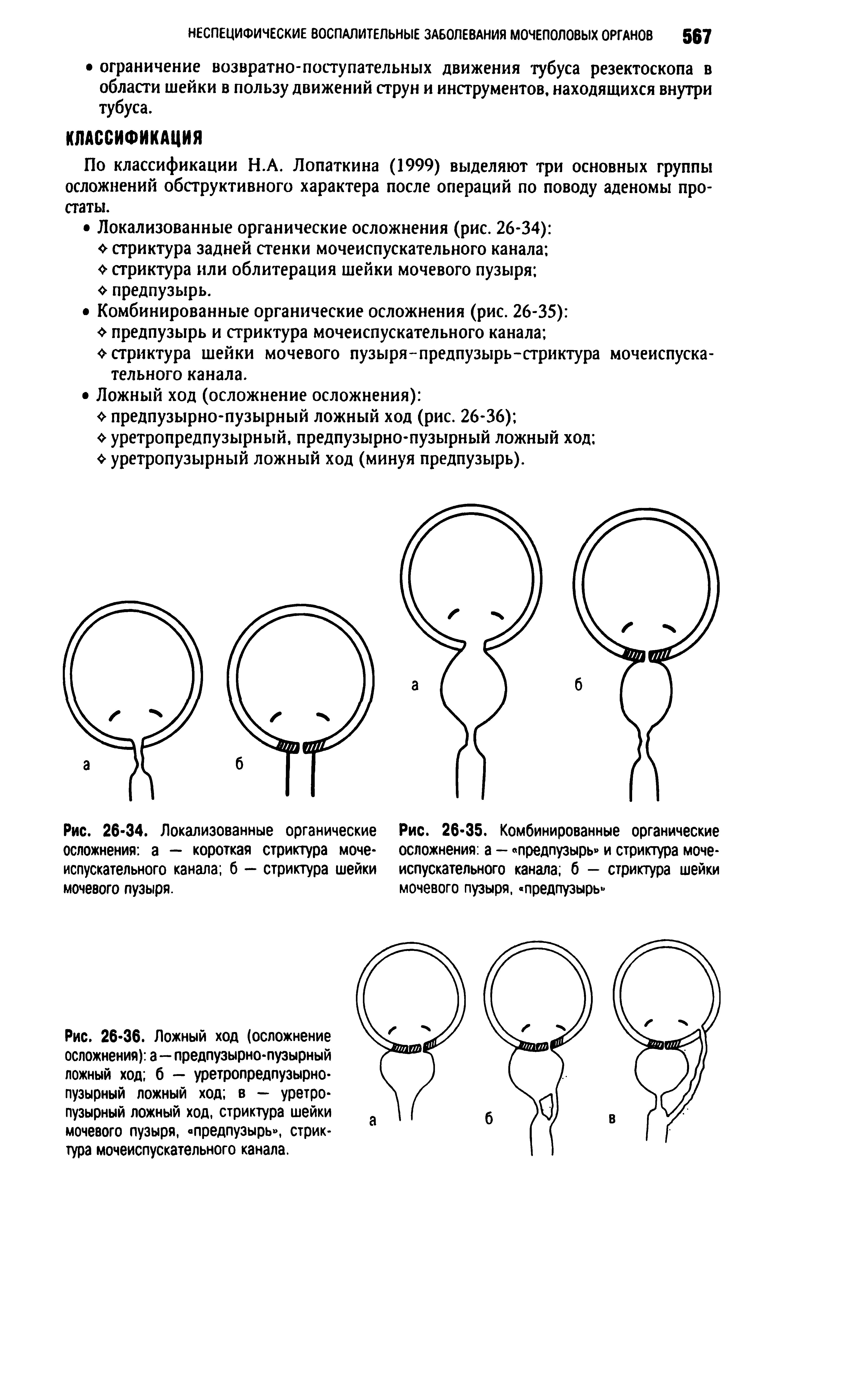 Рис. 26-36. Ложный ход (осложнение осложнения) а—предпузырно-пузырный ложный ход б — уретропредпузырно-пузырный ложный ход в — уретропузырный ложный ход, стриктура шейки мочевого пузыря, предпузырь , стриктура мочеиспускательного канала.