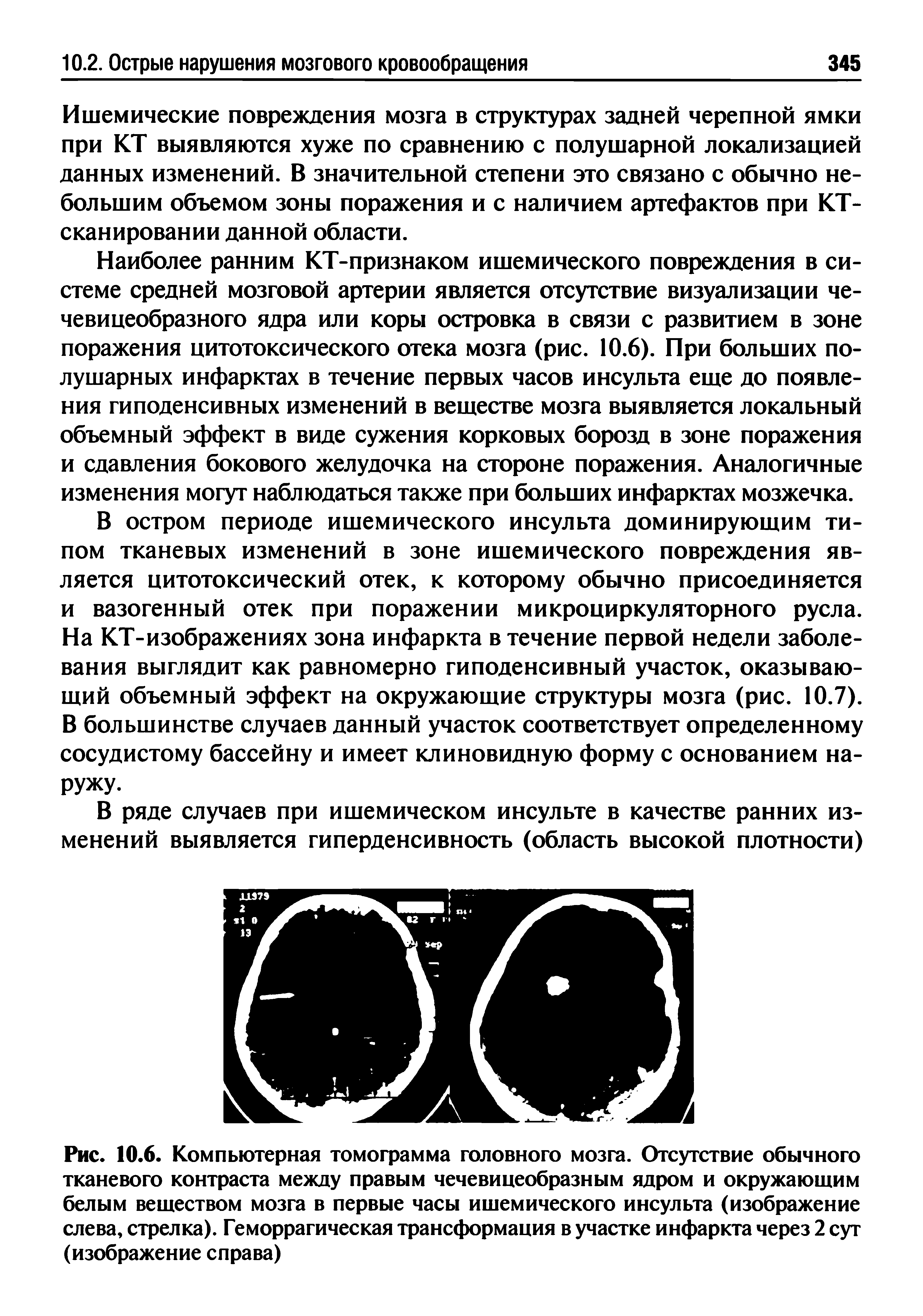 Рис. 10.6. Компьютерная томограмма головного мозга. Отсутствие обычного тканевого контраста между правым чечевицеобразным ядром и окружающим белым веществом мозга в первые часы ишемического инсульта (изображение слева, стрелка). Геморрагическая трансформация в участке инфаркта через 2 сут (изображение справа)...