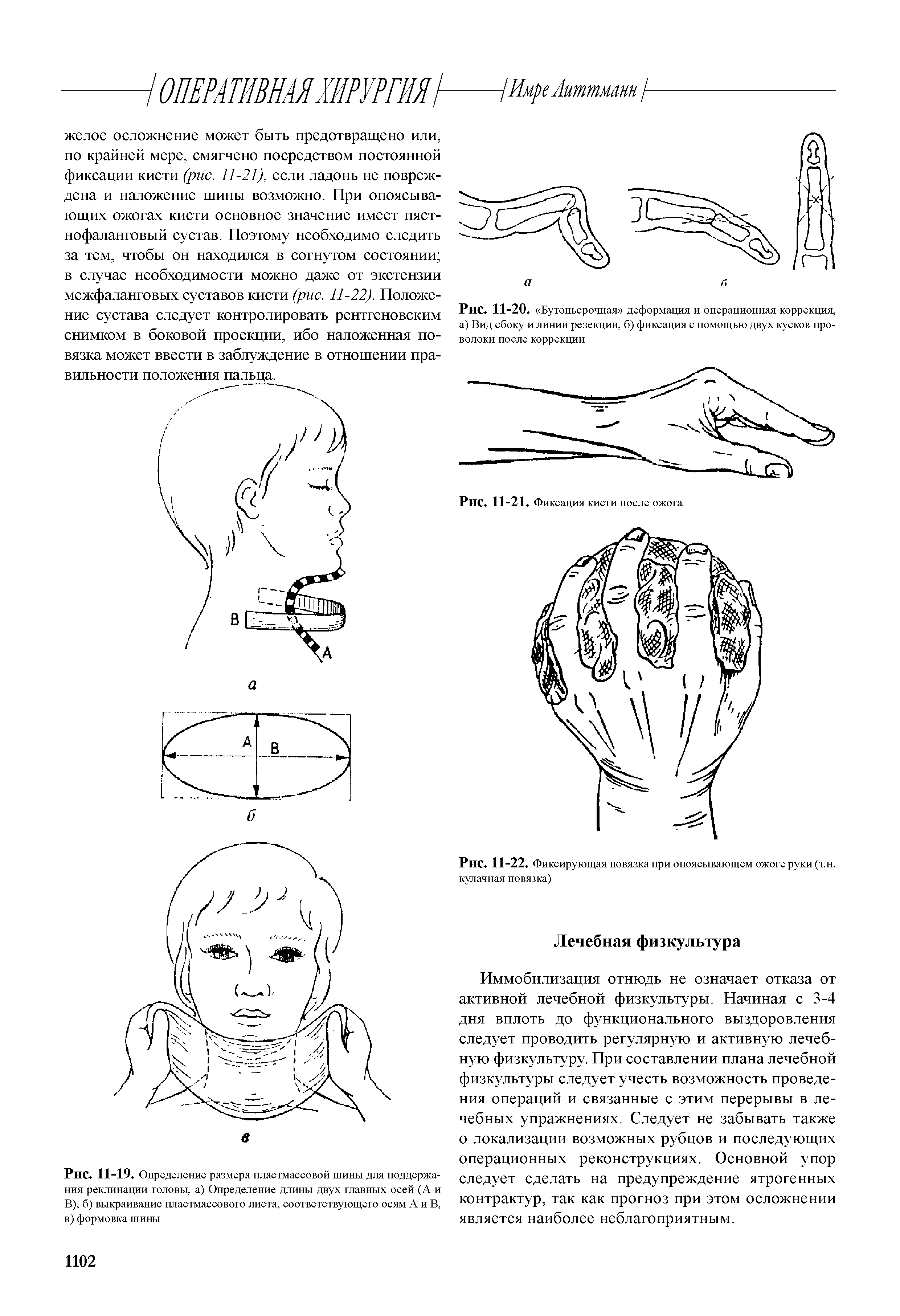 Рис. 11-22. Фиксирующая повязка при опоясывающем ожоге руки (т.н. кулачная повязка)...