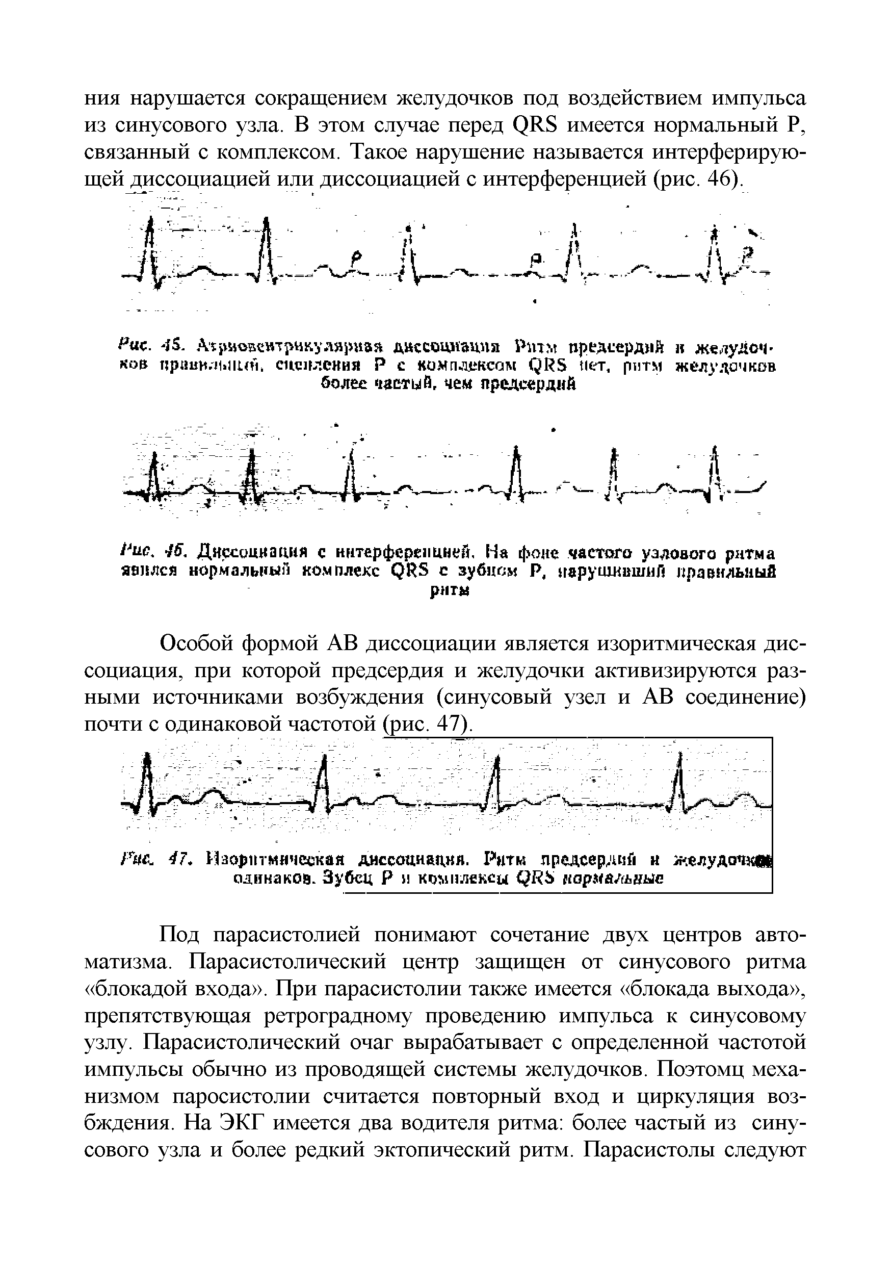 Рис. 46. Диссоциация с интерференцией. На фоне частого узлового ритма явился нормальный комплекс РРЭ с зубцам Р, нарушивший правильный ритм...