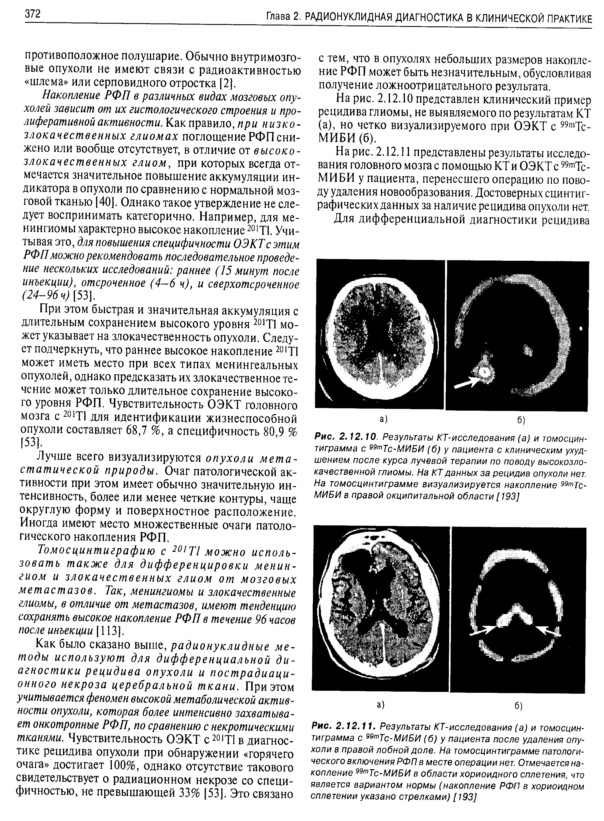 Рис. 2.12.10. Результаты КТ-исследования (а) и томосцин-тиграмма с 99тТс-МИБИ (б) у пациента с клиническим ухудшением после курса лучевой терапии по поводу высокозлокачественной глиомы. На КТ данных за рецидив опухоли нет. На томосцинтиграмме визуализируется накопление 99тТс-МИБИ в правой окципитальной области [ 193]...