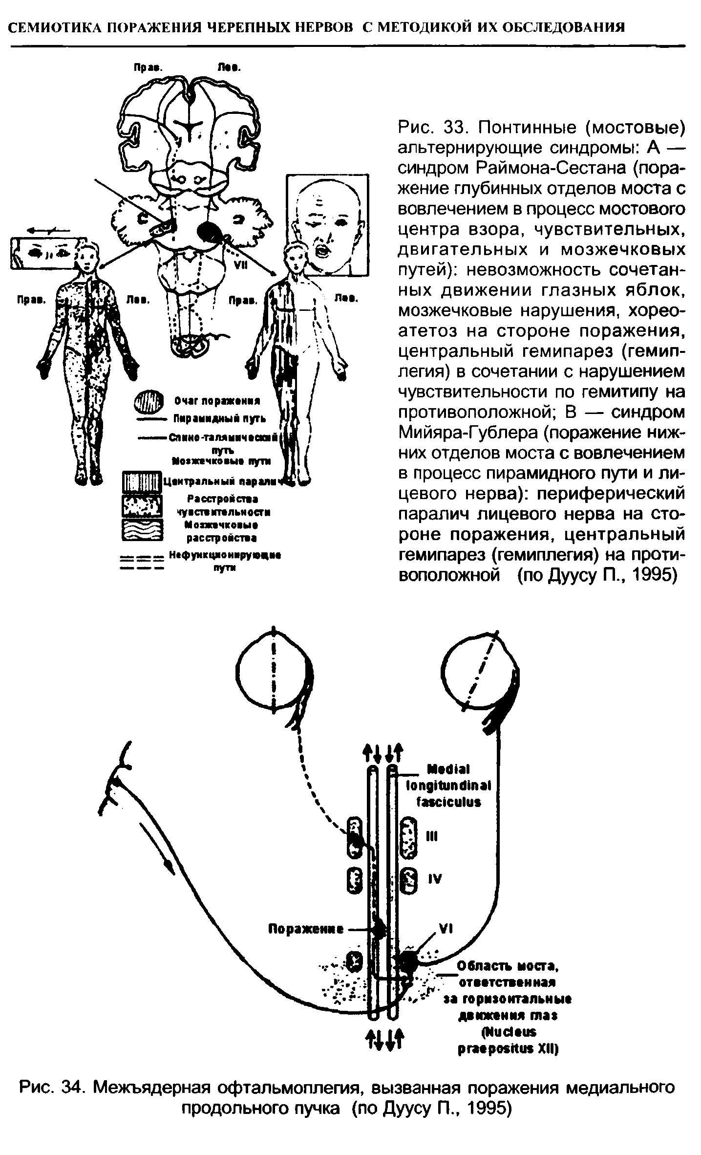 Рис. 34. Межъядерная офтальмоплегия, вызванная поражения медиального продольного пучка (по Дуусу П 1995)...