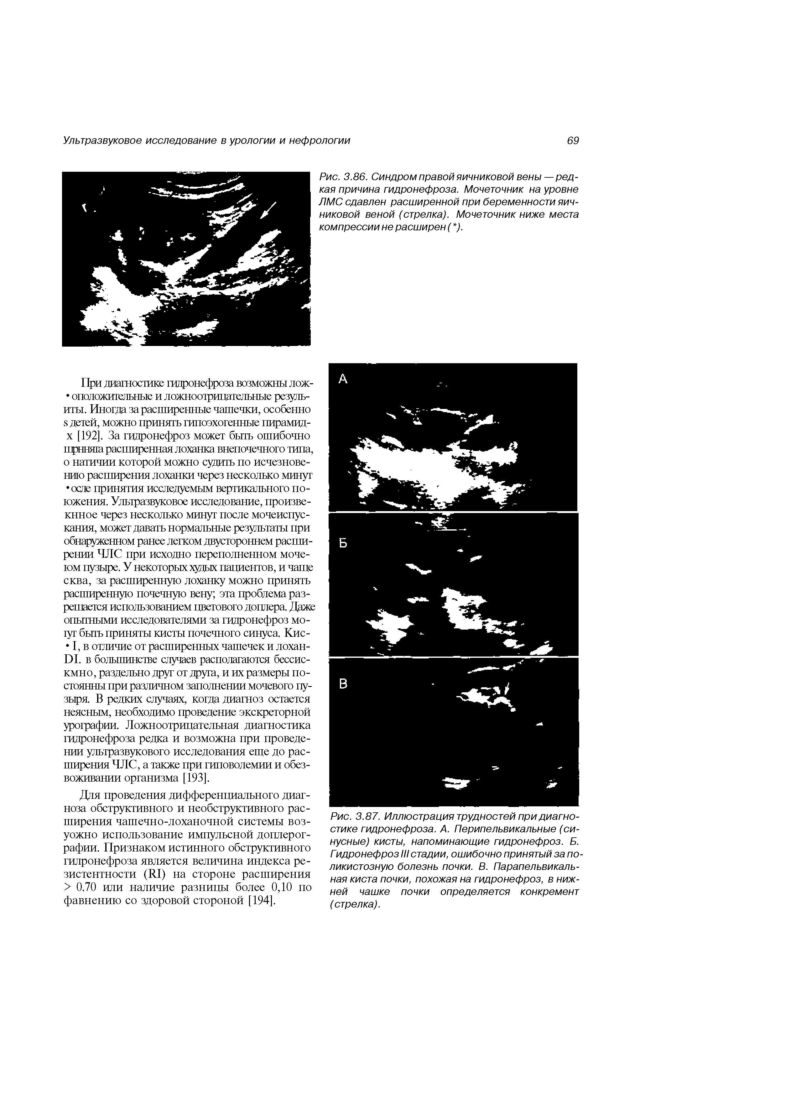 Рис. 3.86. Синдром правой яичниковой вены—редкая причина гидронефроза. Мочеточник на уровне ЛМС сдавлен расширенной при беременности яичниковой веной (стрелка). Мочеточник ниже места компрессии не расширен ( ).