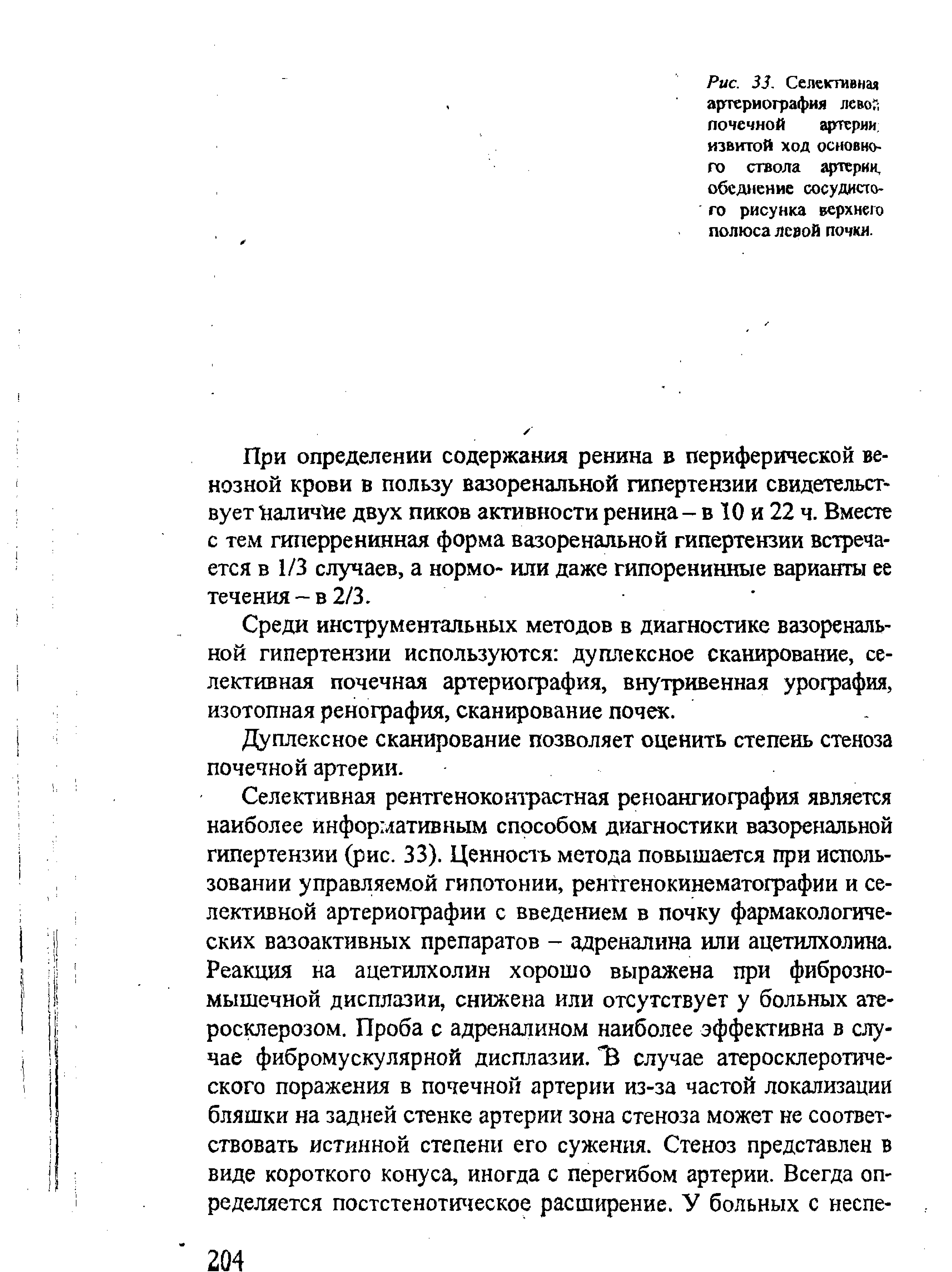 Рис. 33. Селективная артериография левой почечной артерии извитой ход основного ствола артерии, обеднение сосудистого рисунка верхнею полюса левой почки.